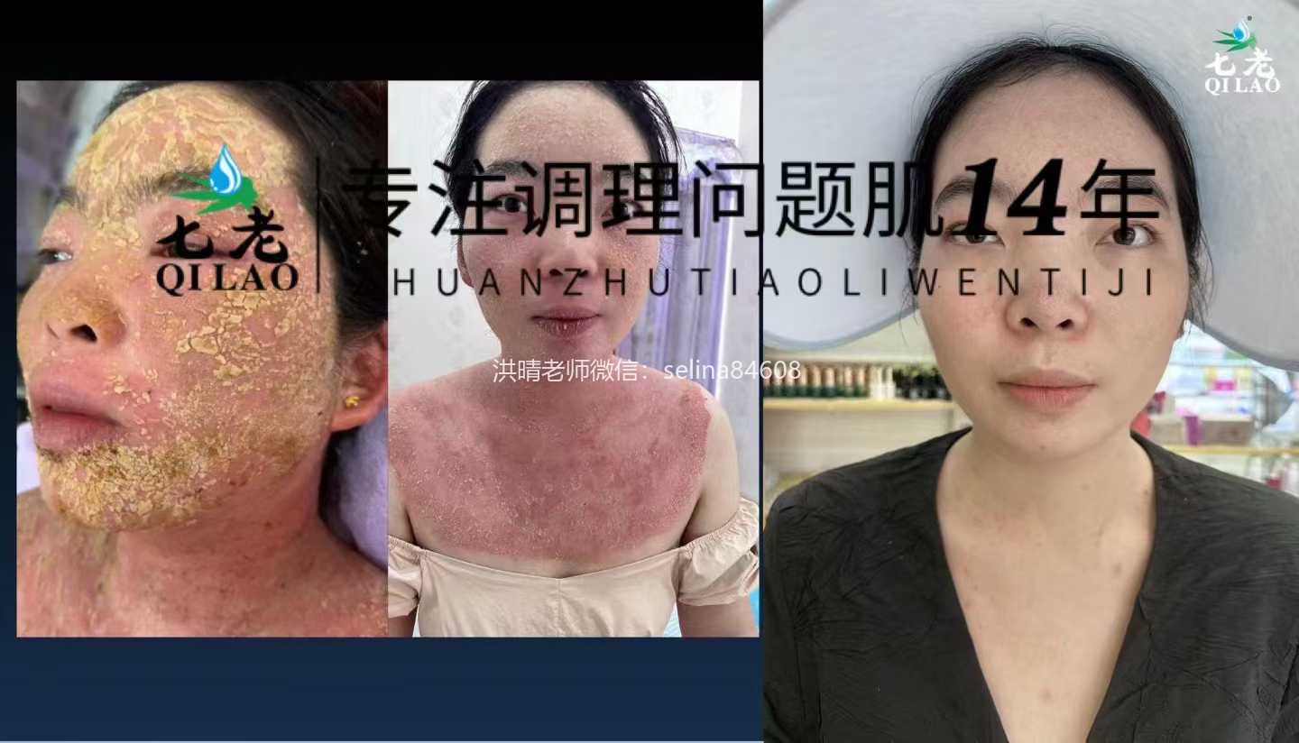 七老重度激素脸红肿痒痛疹子疙瘩渗液流黄水结痂修护案例