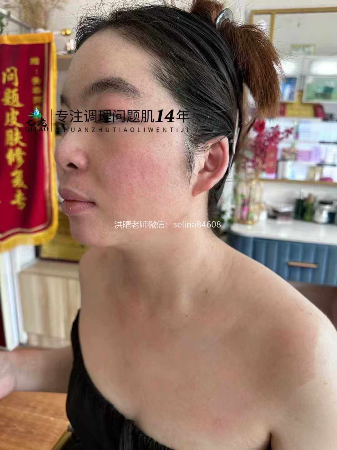 七老重度激素脸红肿痒痛疹子疙瘩渗液流黄水结痂修护案例