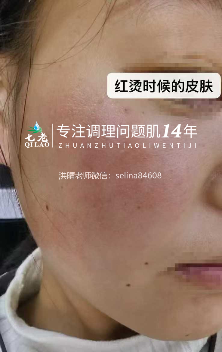 七老发红发烫大红脸修护案例