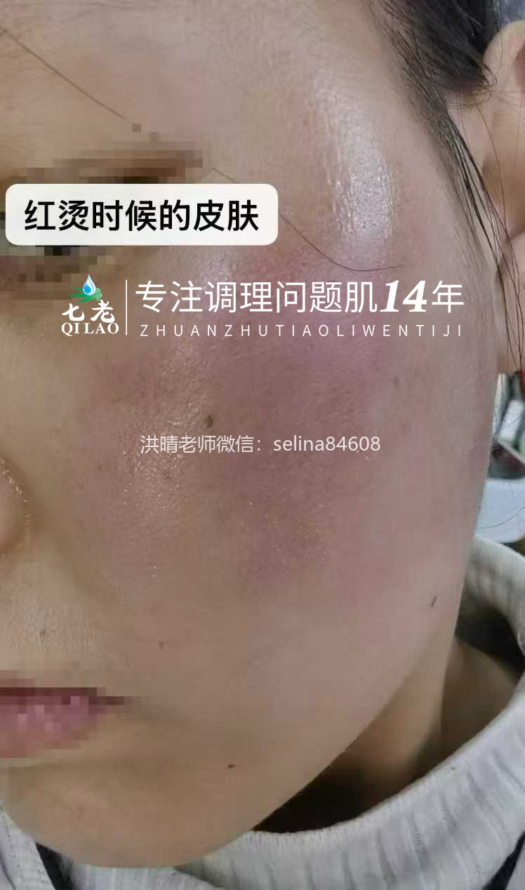 七老发红发烫大红脸修护案例