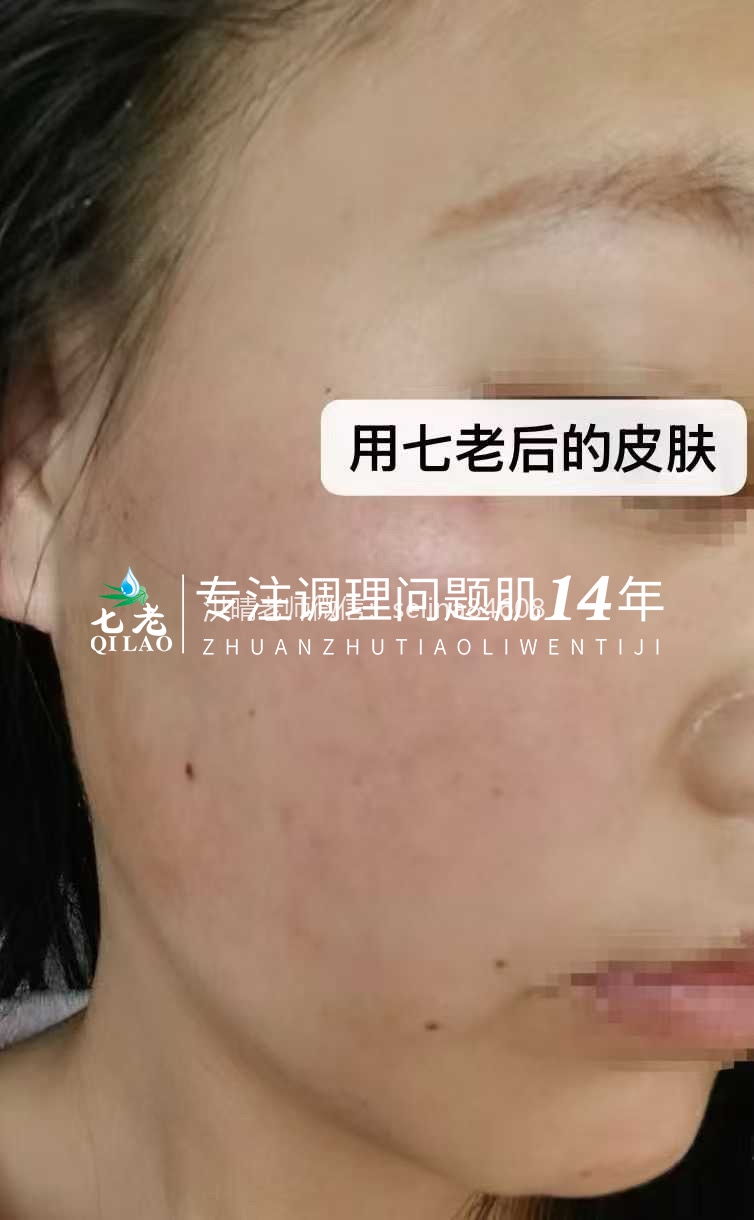 七老发红发烫大红脸修护案例