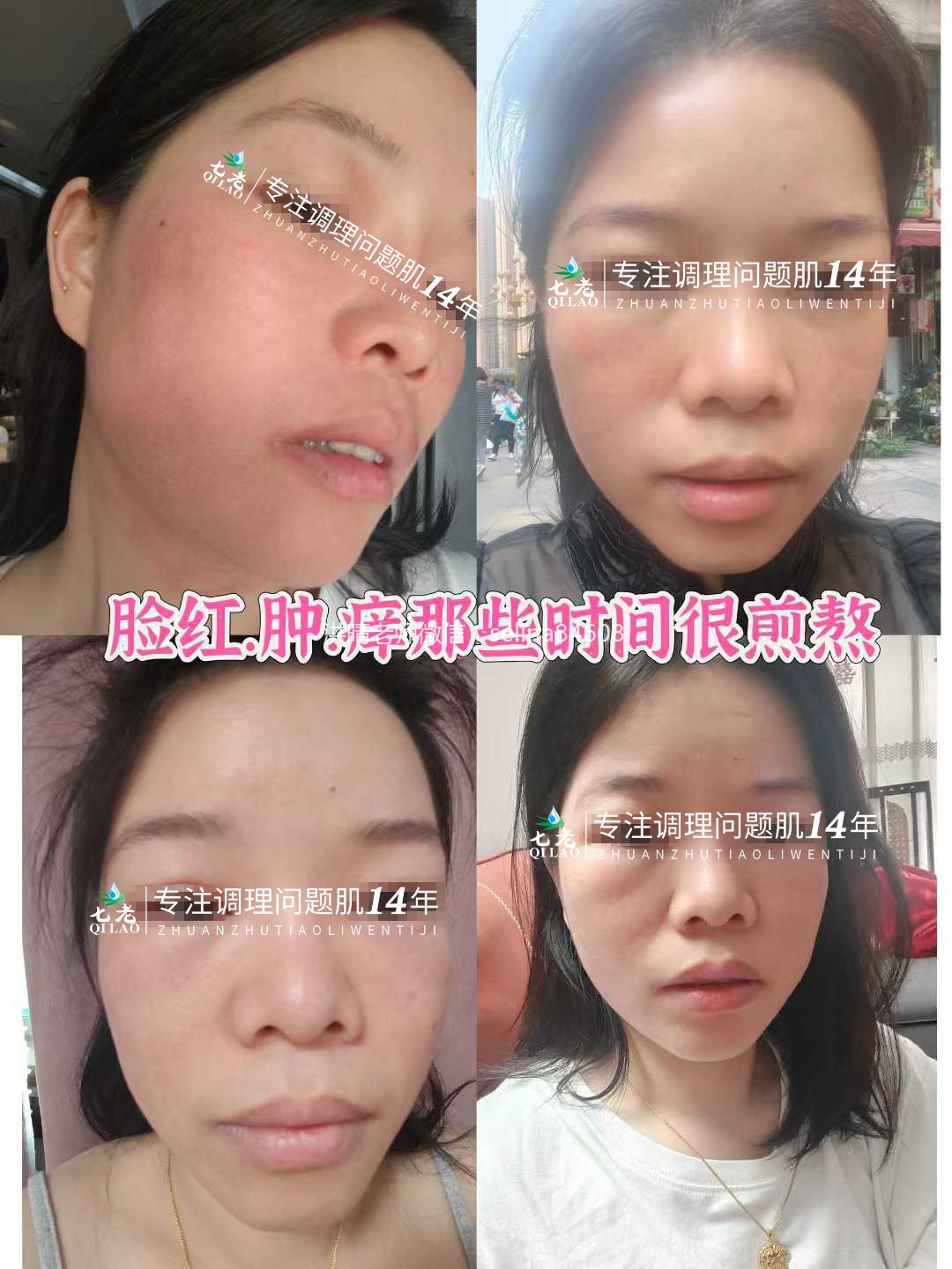 七老激素脸内调外修，恢复健康肤质，健康体质