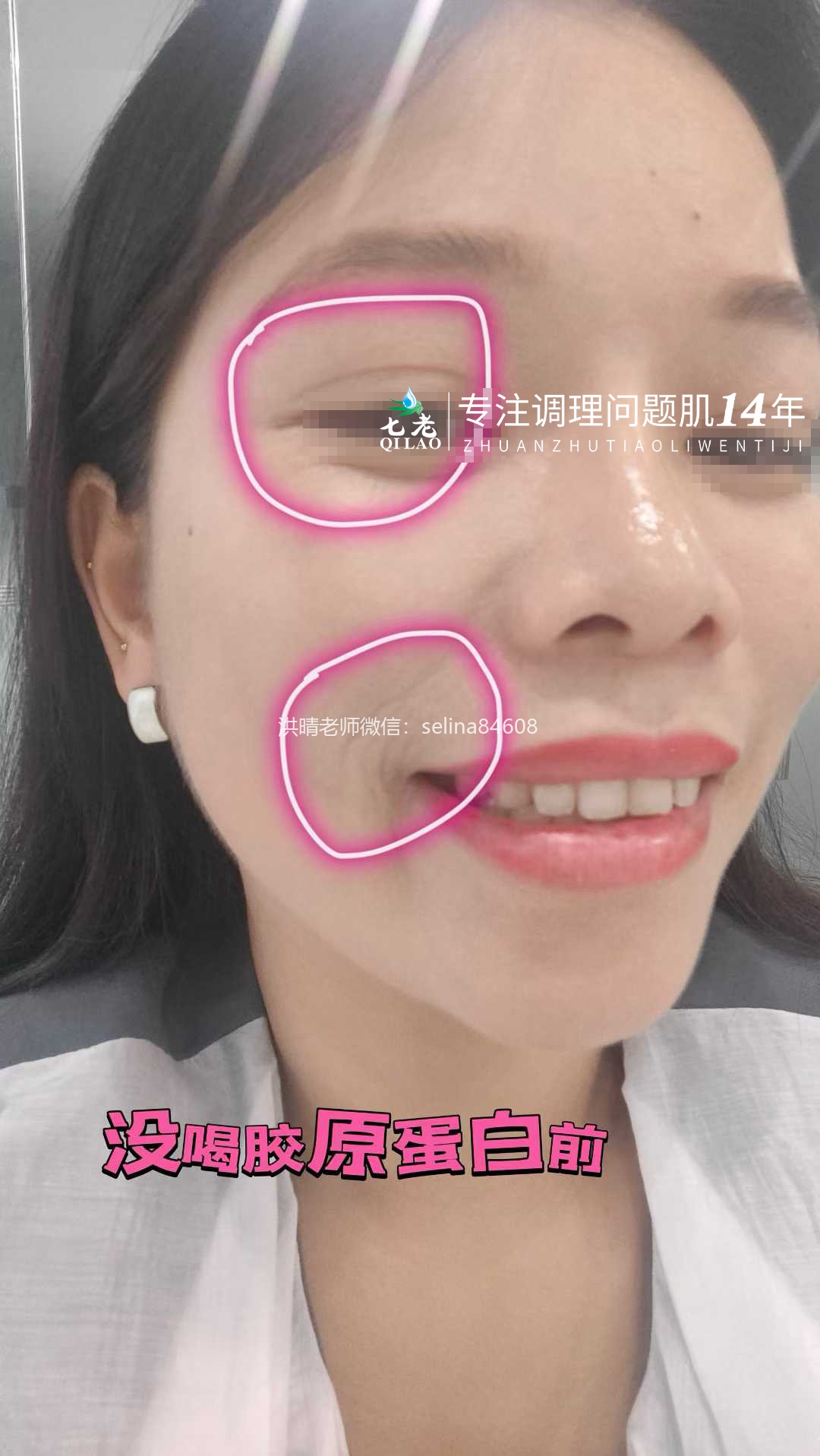 七老激素脸内调外修，恢复健康肤质，健康体质