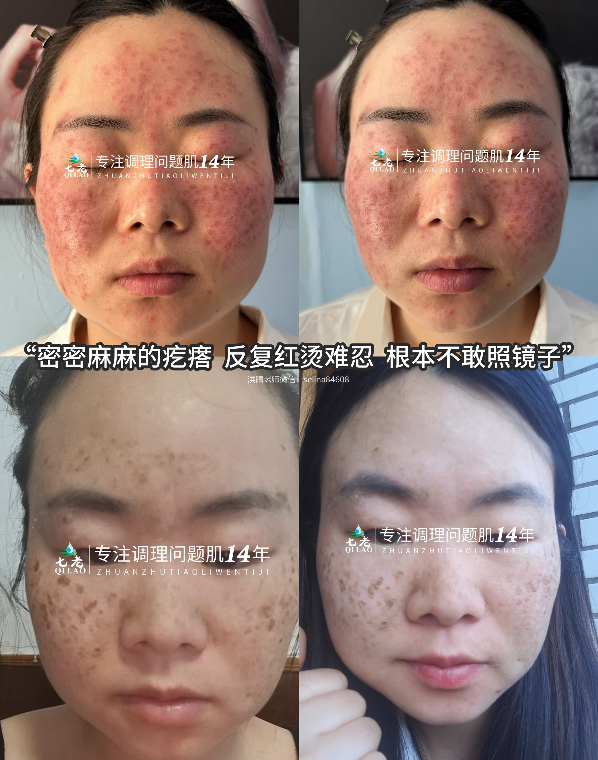 七老剥脱祛斑屏障受损激素脸修护案例