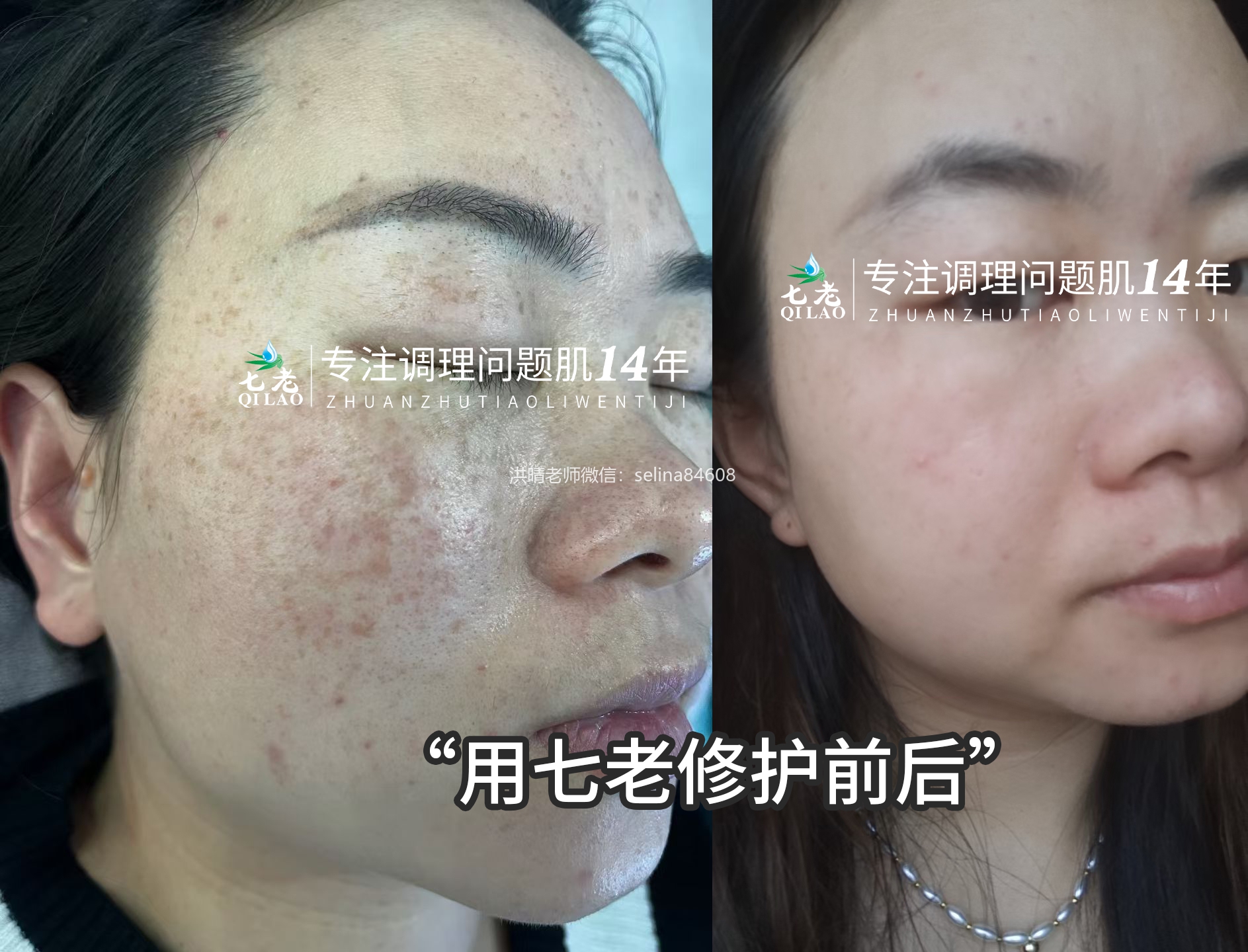 七老剥脱祛斑屏障受损激素脸修护案例