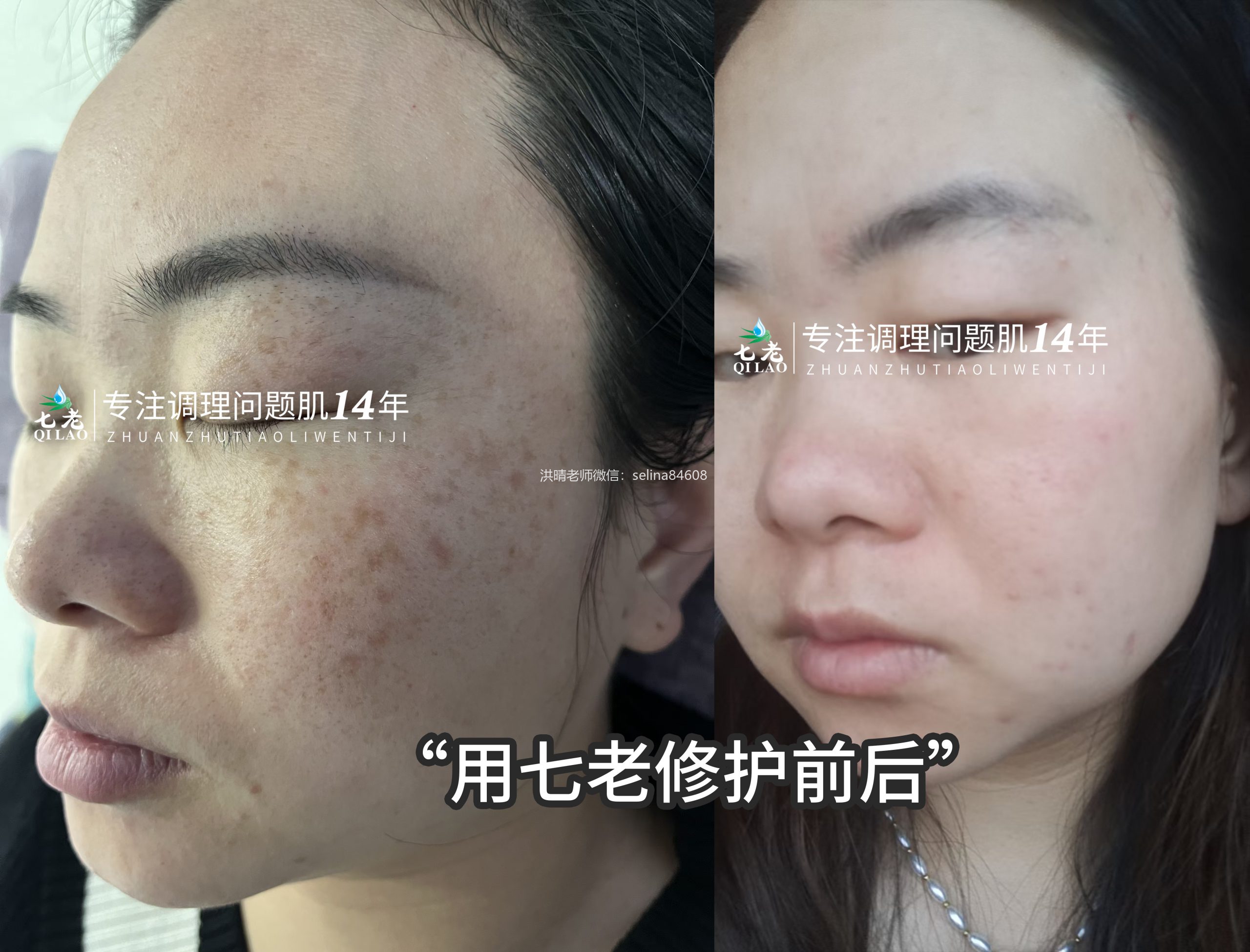 七老剥脱祛斑屏障受损激素脸修护案例