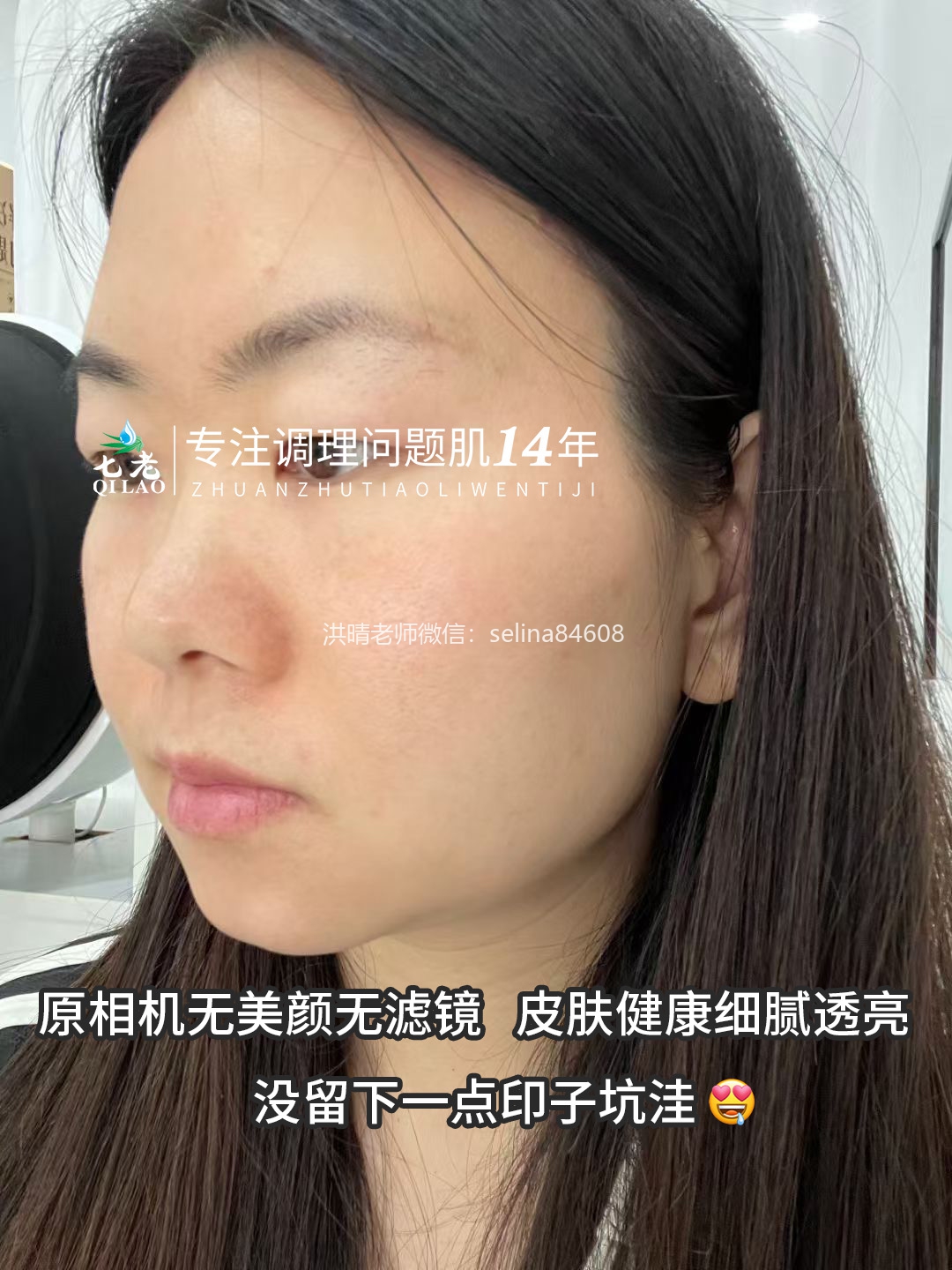 七老剥脱祛斑屏障受损激素脸修护案例