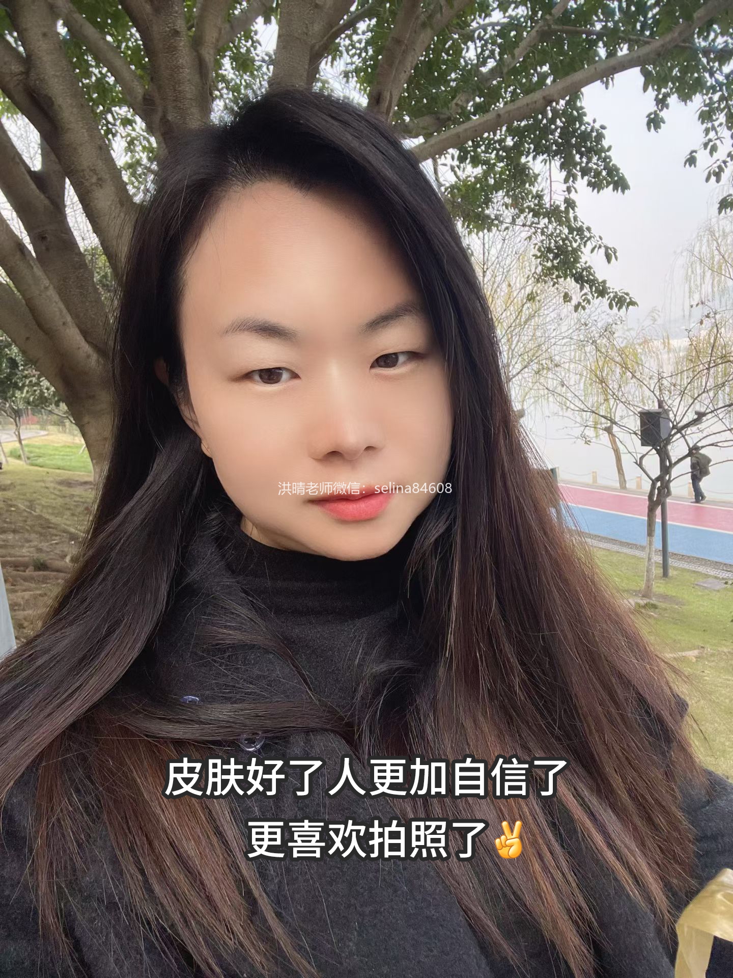 七老剥脱祛斑屏障受损激素脸修护案例