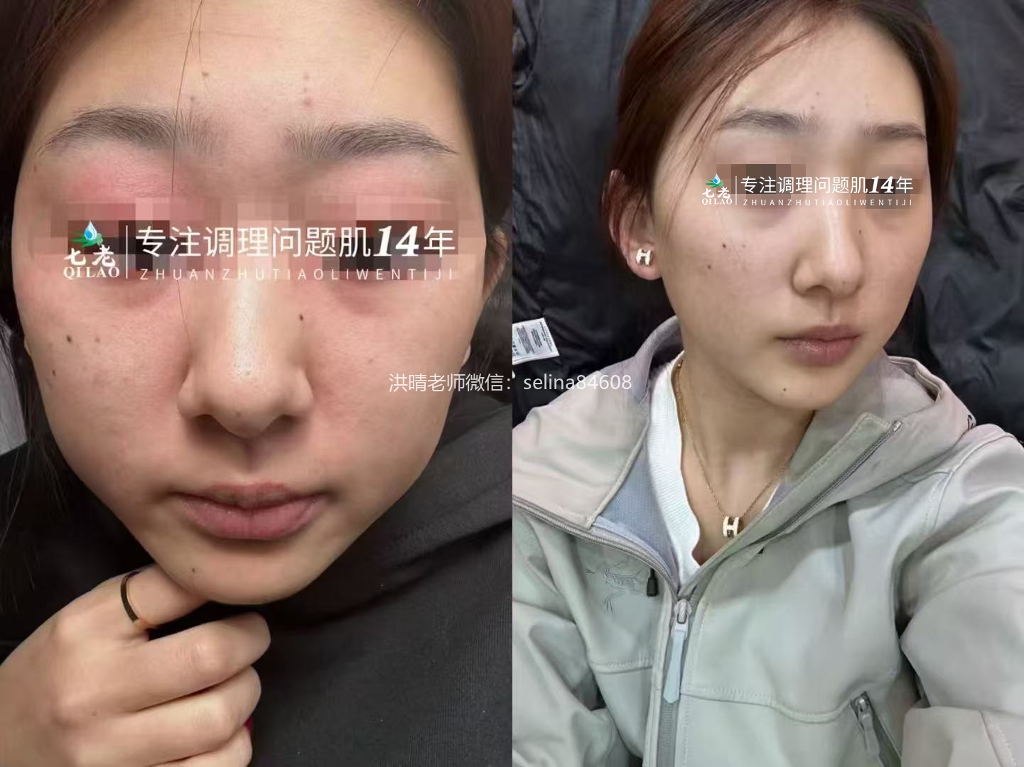 七老眼周反复过敏修护案例