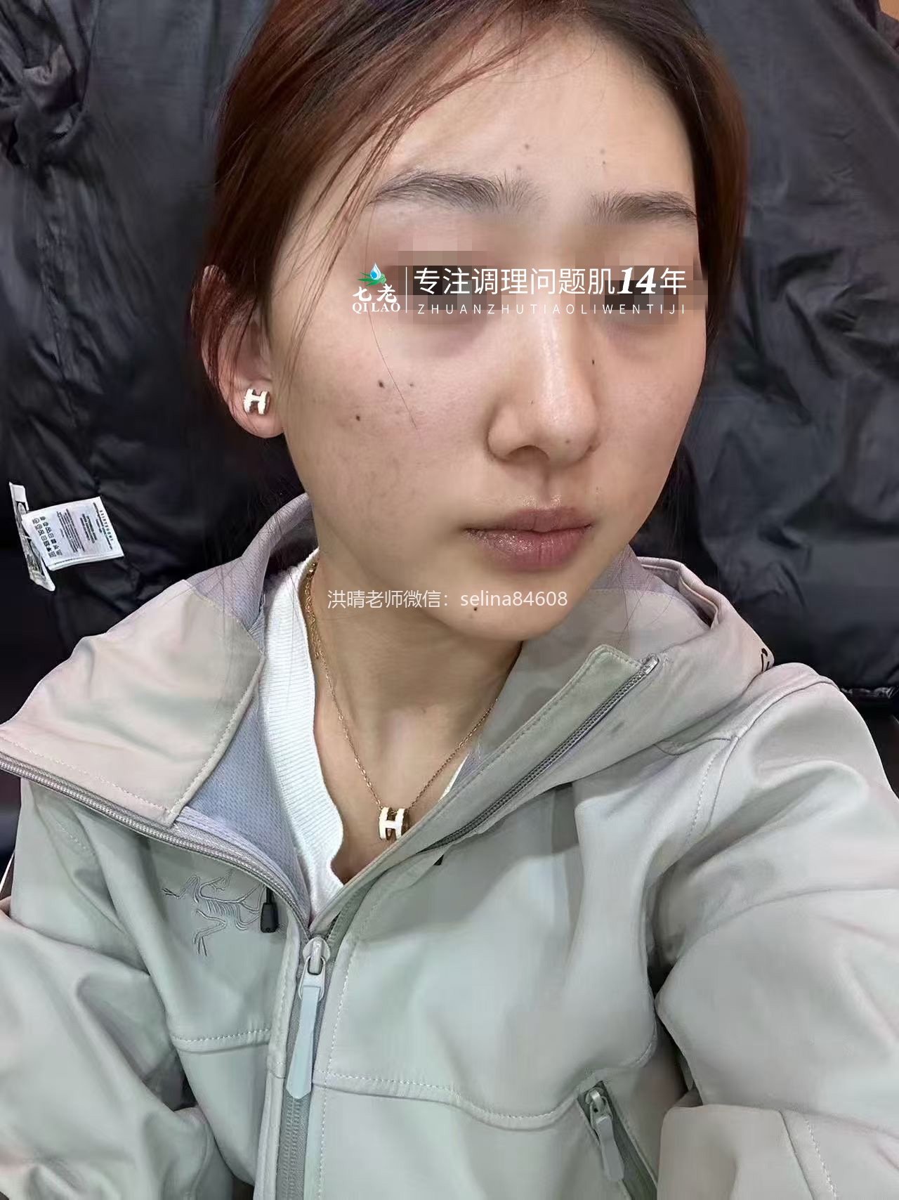 七老眼周反复过敏修护案例