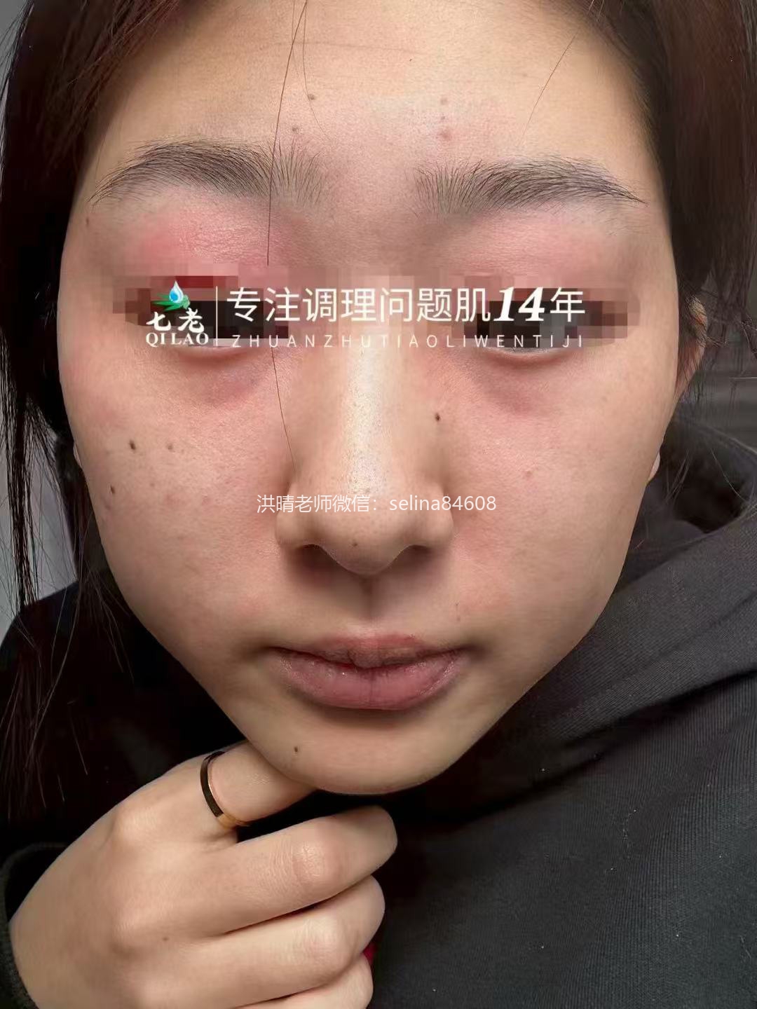 七老眼周反复过敏修护案例