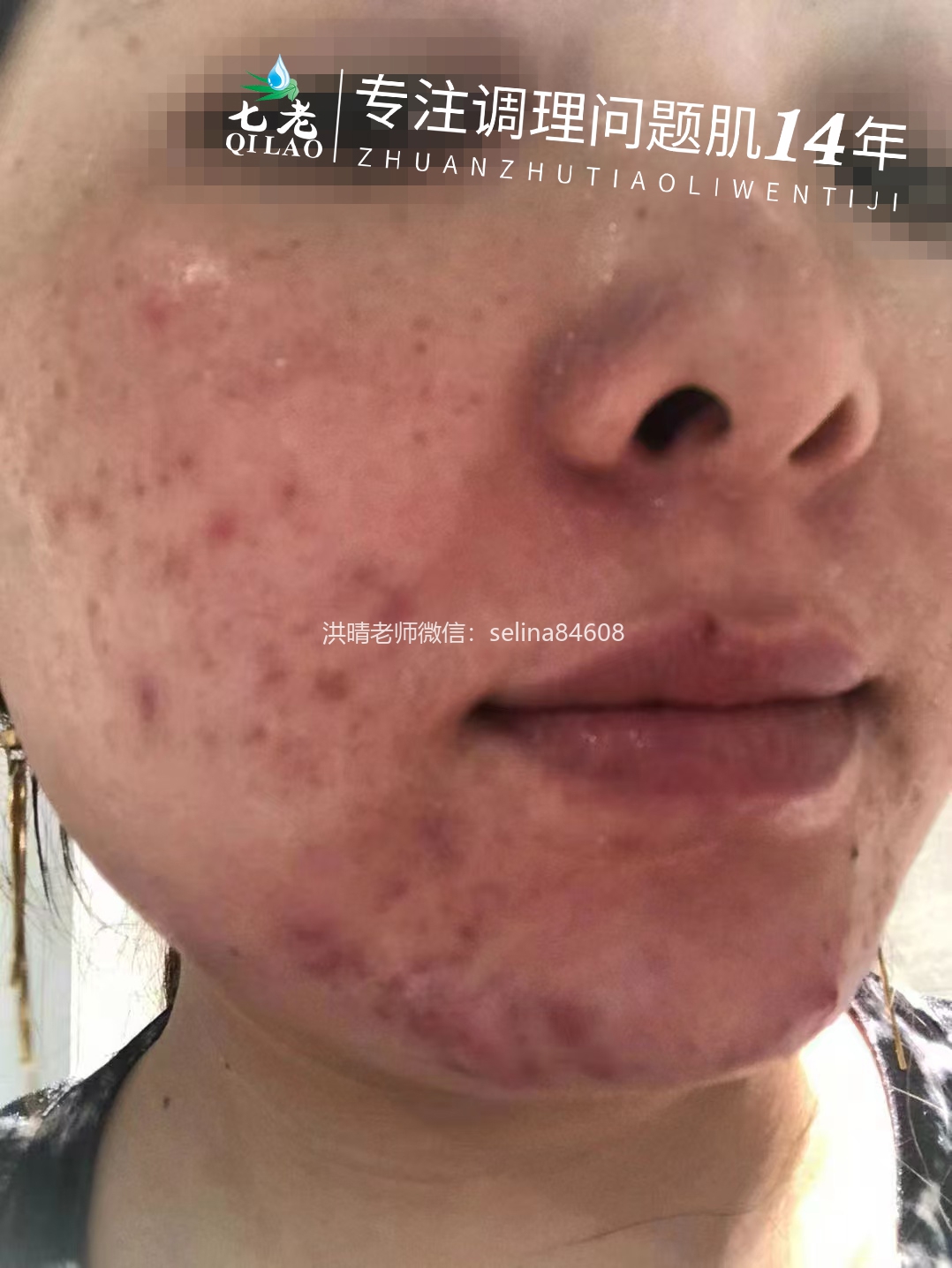 七老激素脸修复案例
