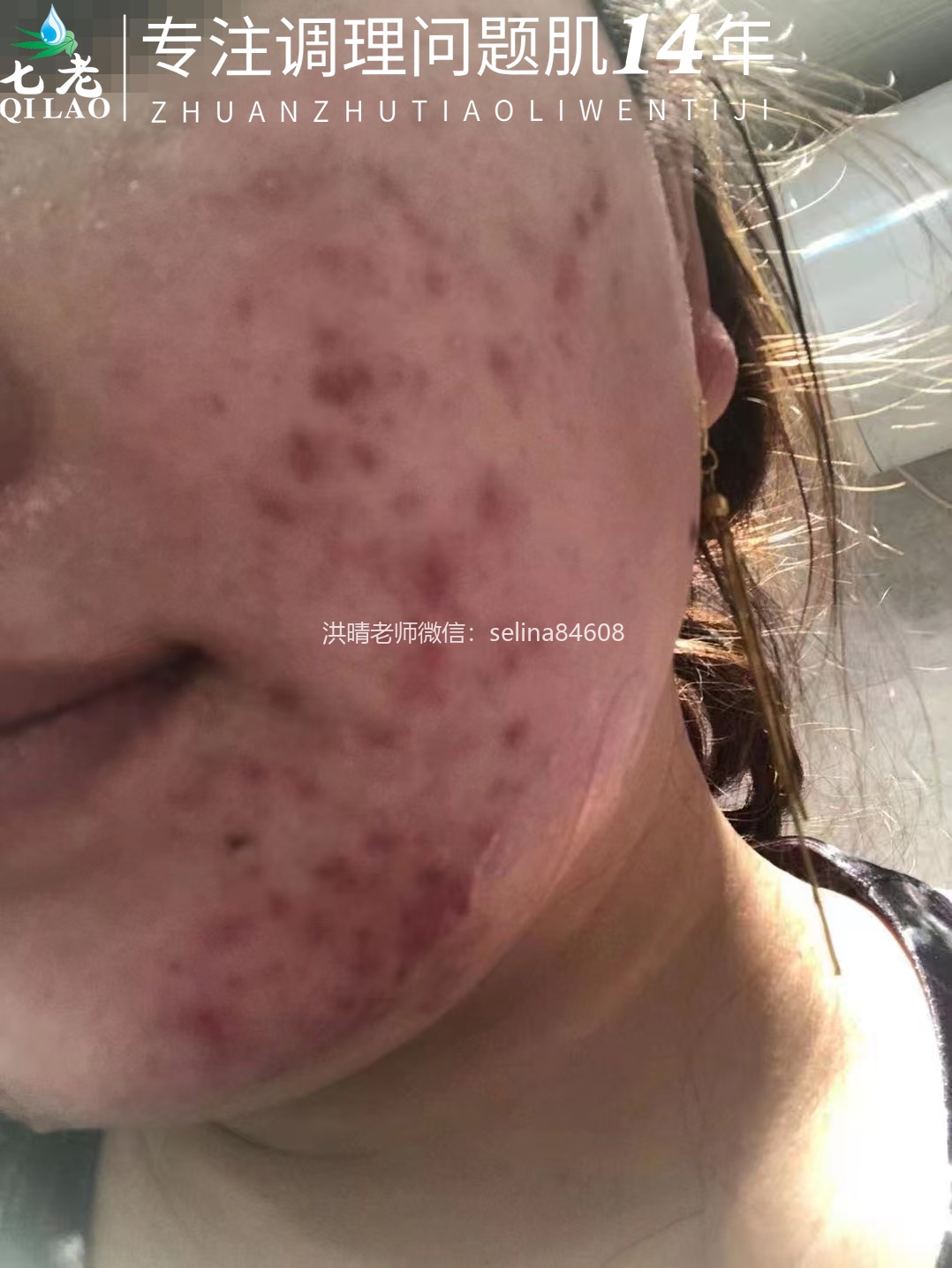 七老激素脸修复案例