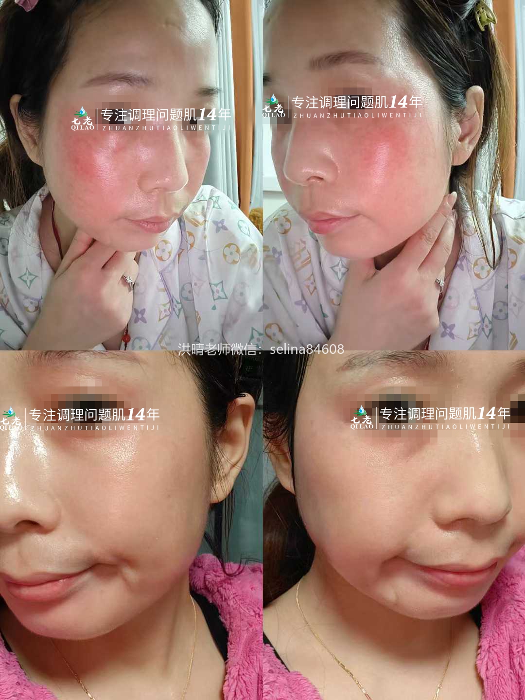 七老屏障受损角质层薄红热修复案例