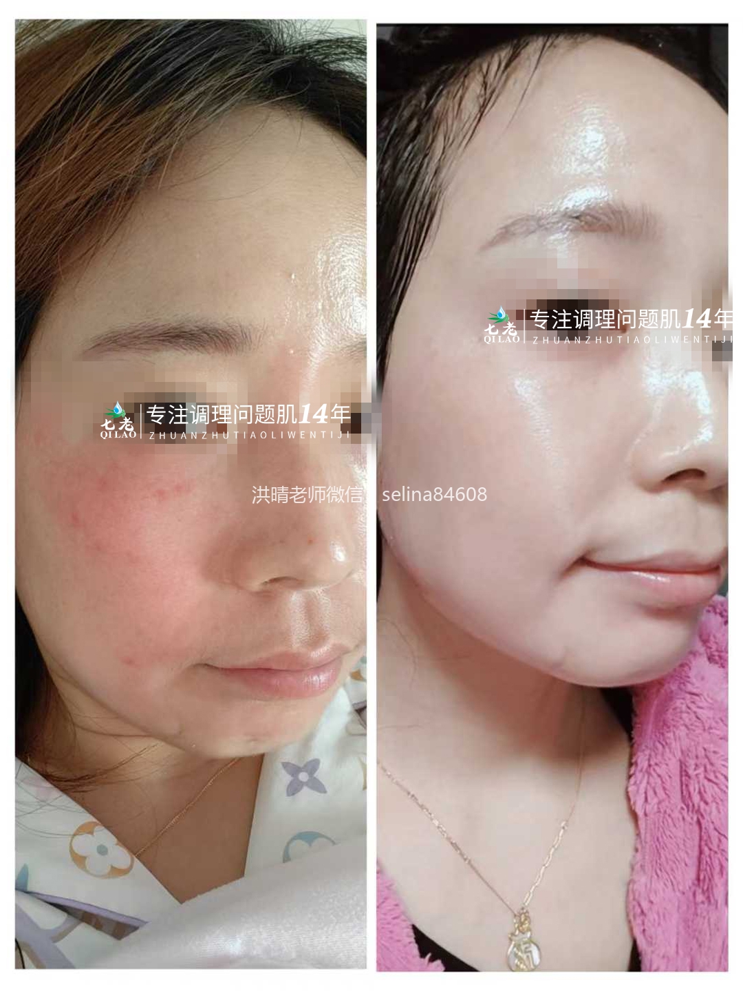 七老屏障受损角质层薄红热修复案例