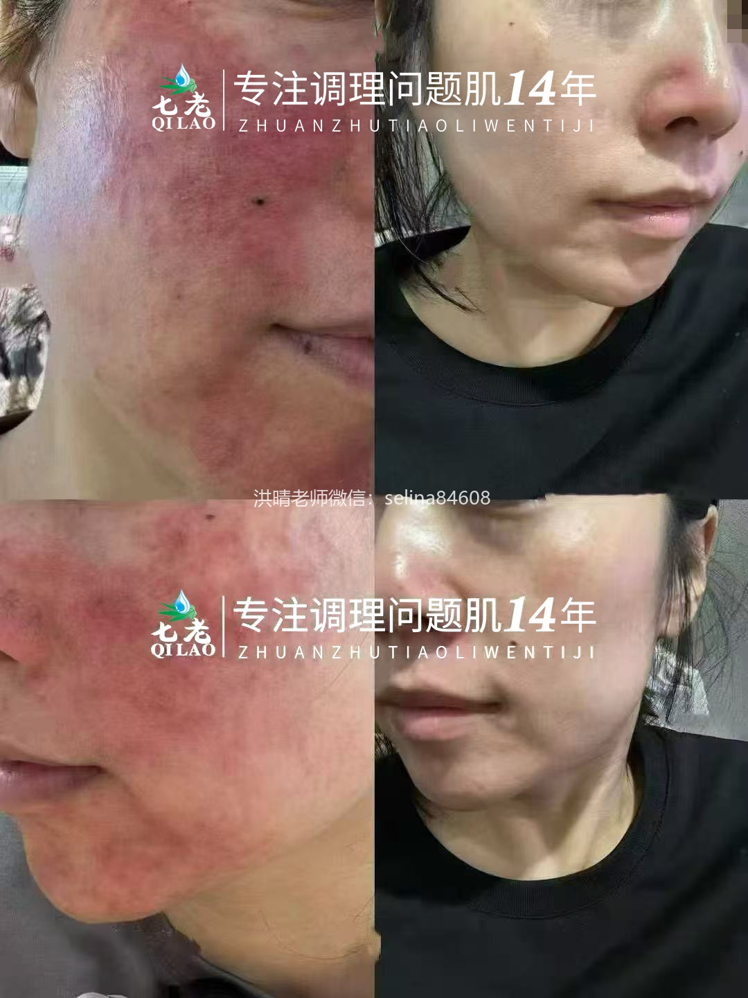 七老激素脸修复案例