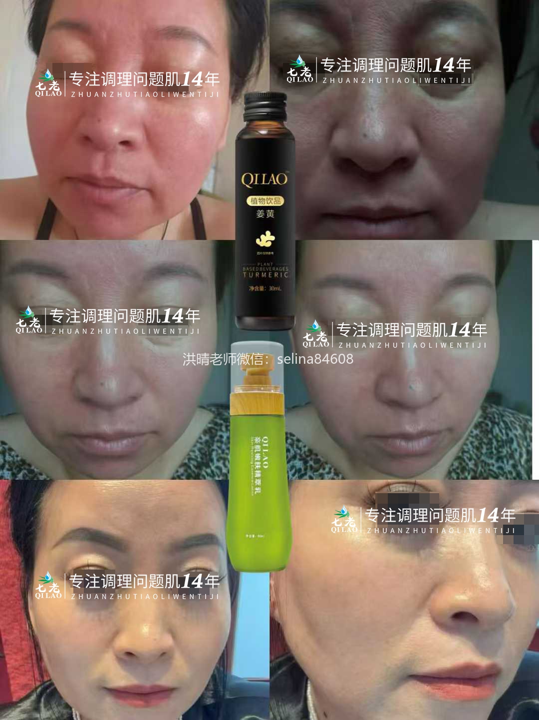 七老激素脸发红发烫角质层薄修护案例