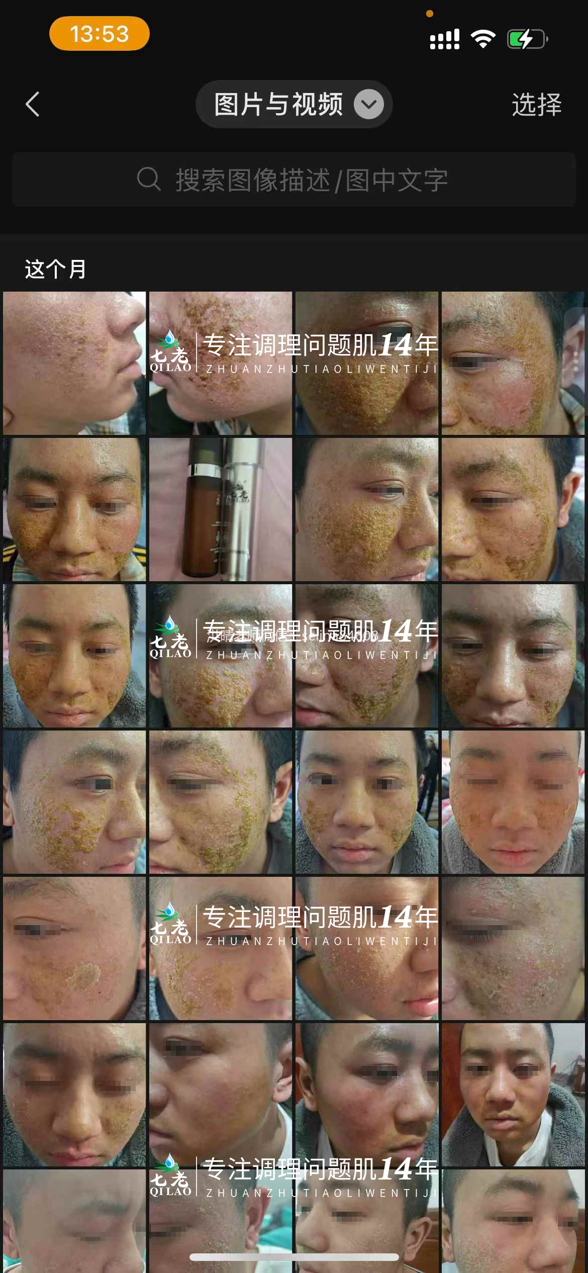 七老严重激素脸修护记录