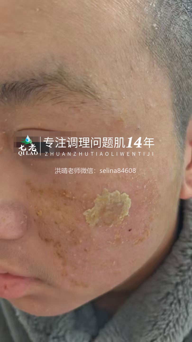 七老严重激素脸修护记录