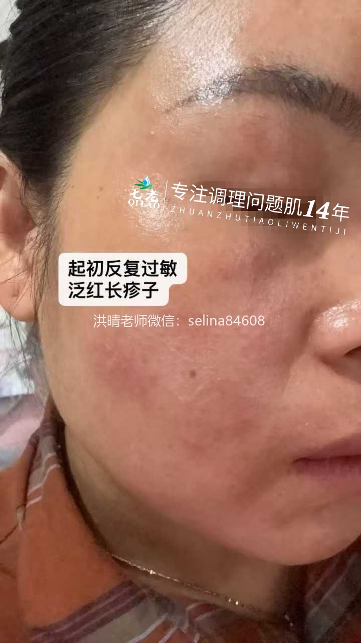 七老屏障受损反复过敏修护案例