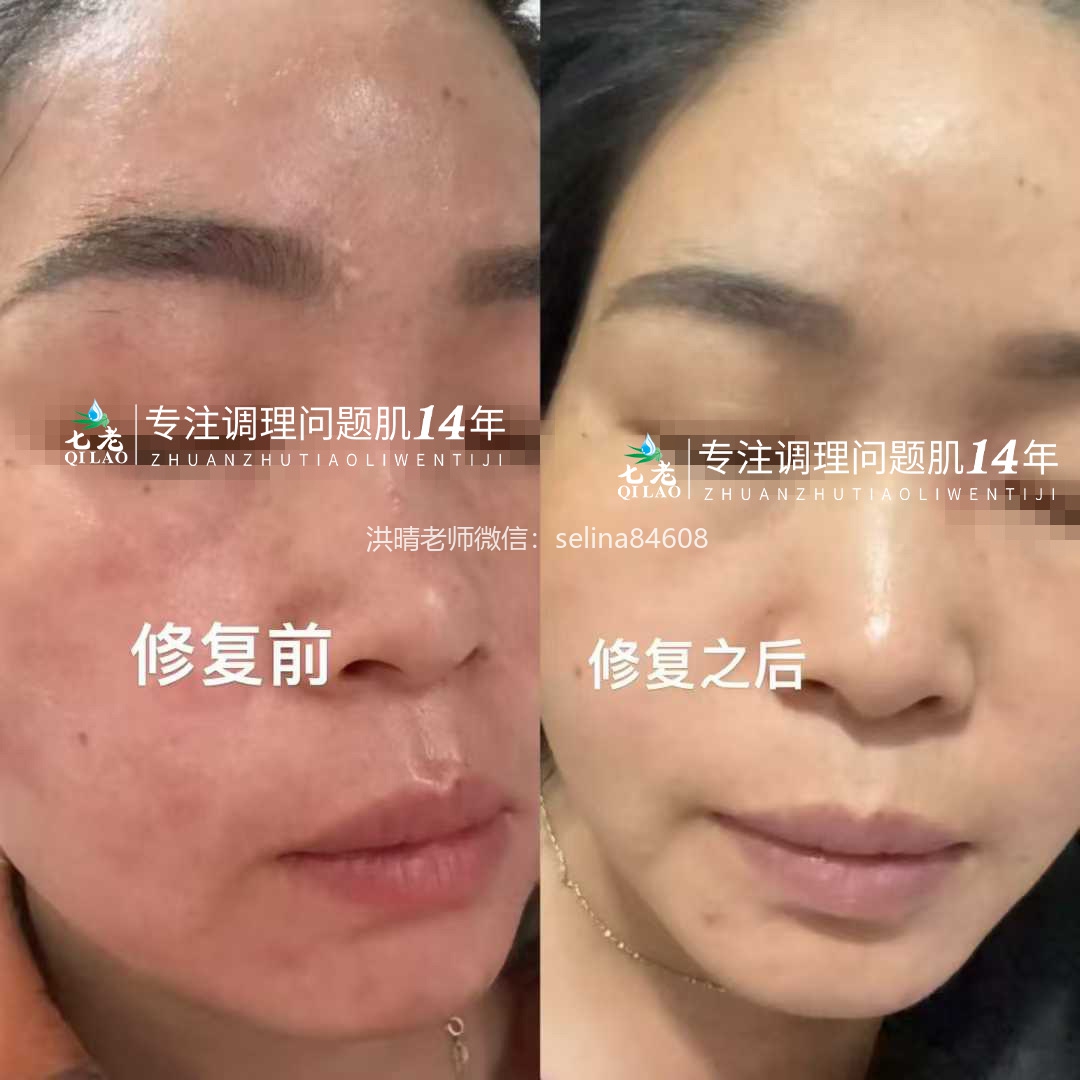 七老屏障受损反复过敏修护案例