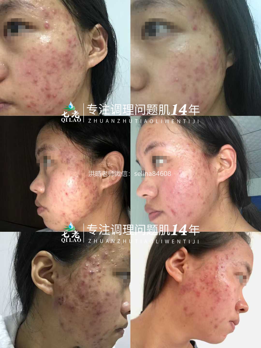 七老激素痘脓包痘修护案例