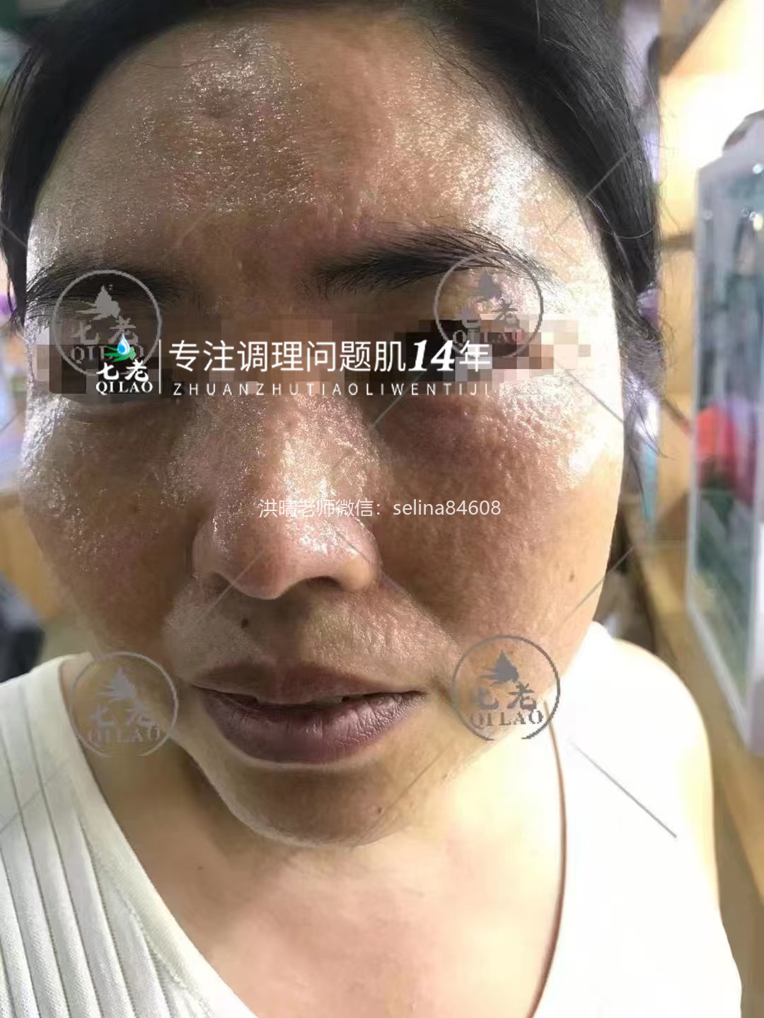 七老日光性皮炎修护案例