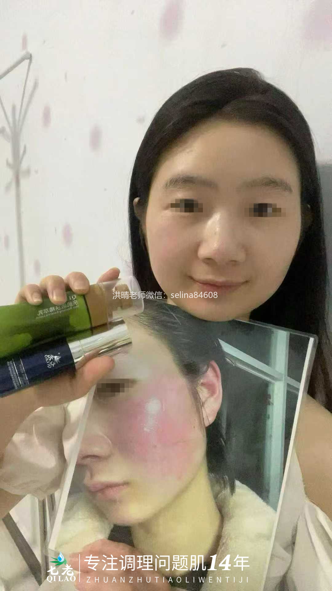 七老激素脸修复案例