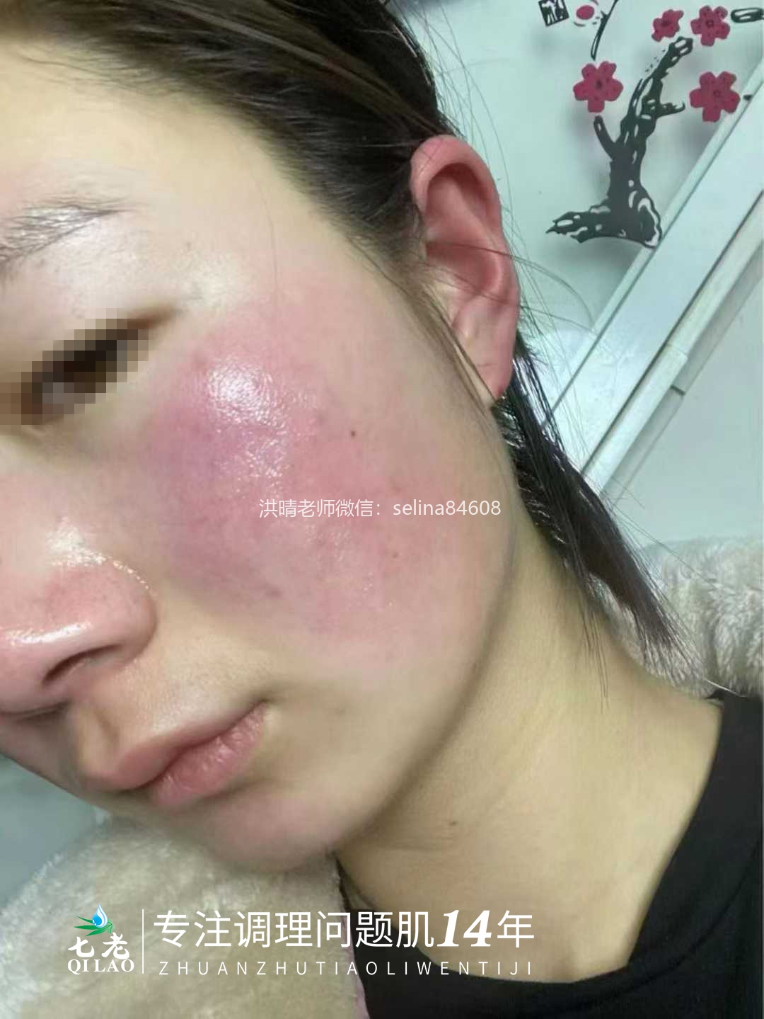 七老激素脸修复案例