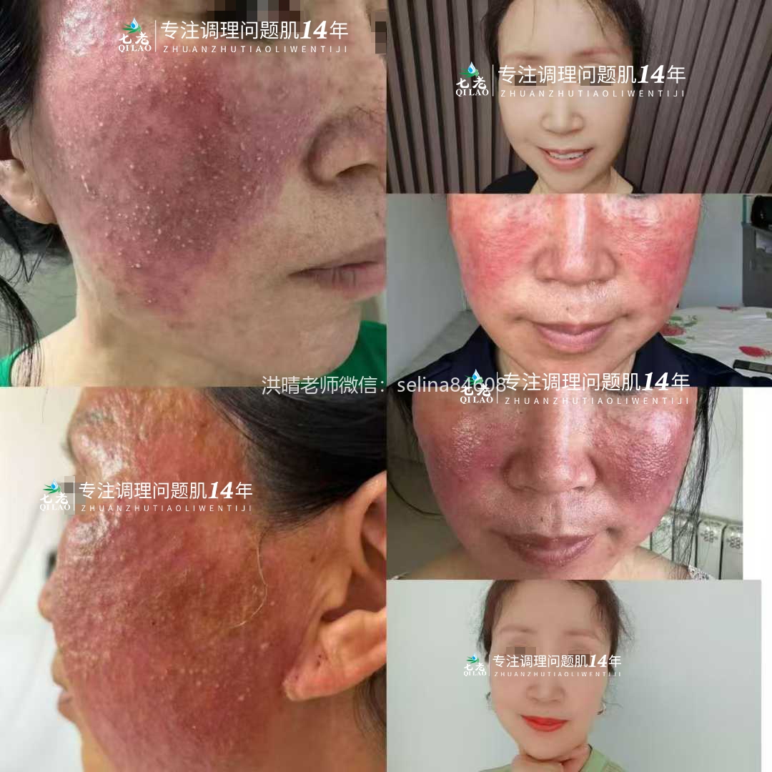 七老严重激素脸案例，从受益者变成守护者