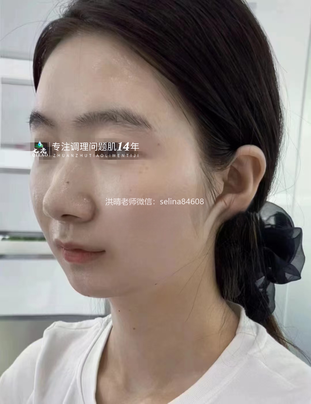 七老激素脸修复案例