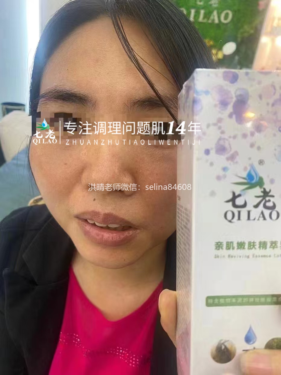 七老日光性皮炎修护案例