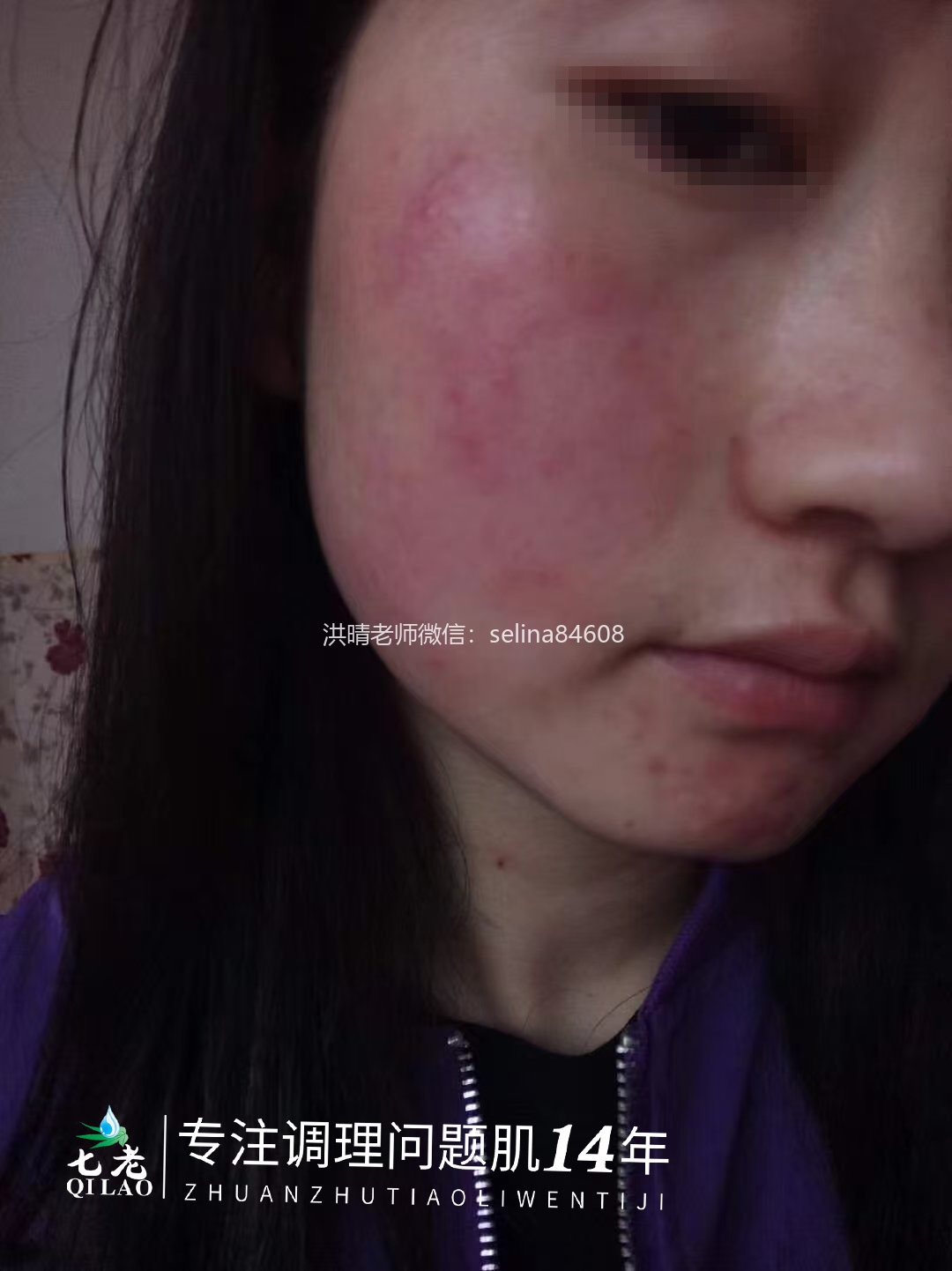 七老激素脸玫瑰皮修复案例