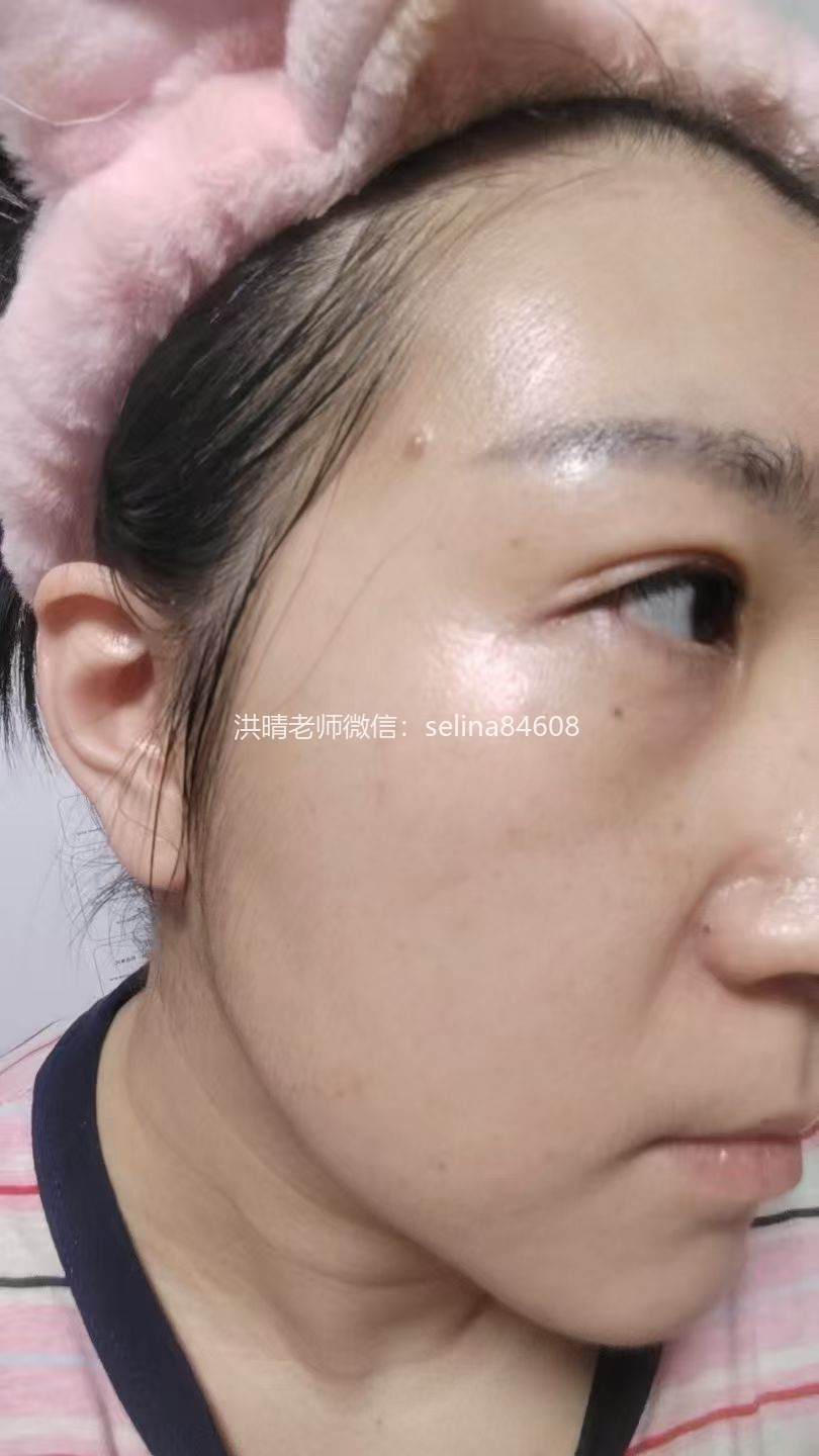 七老严重激素脸修复案例