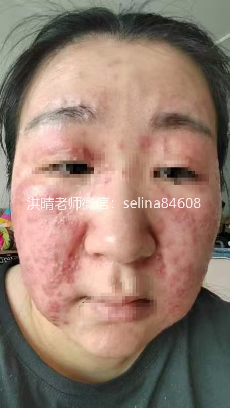 七老严重激素脸修复案例