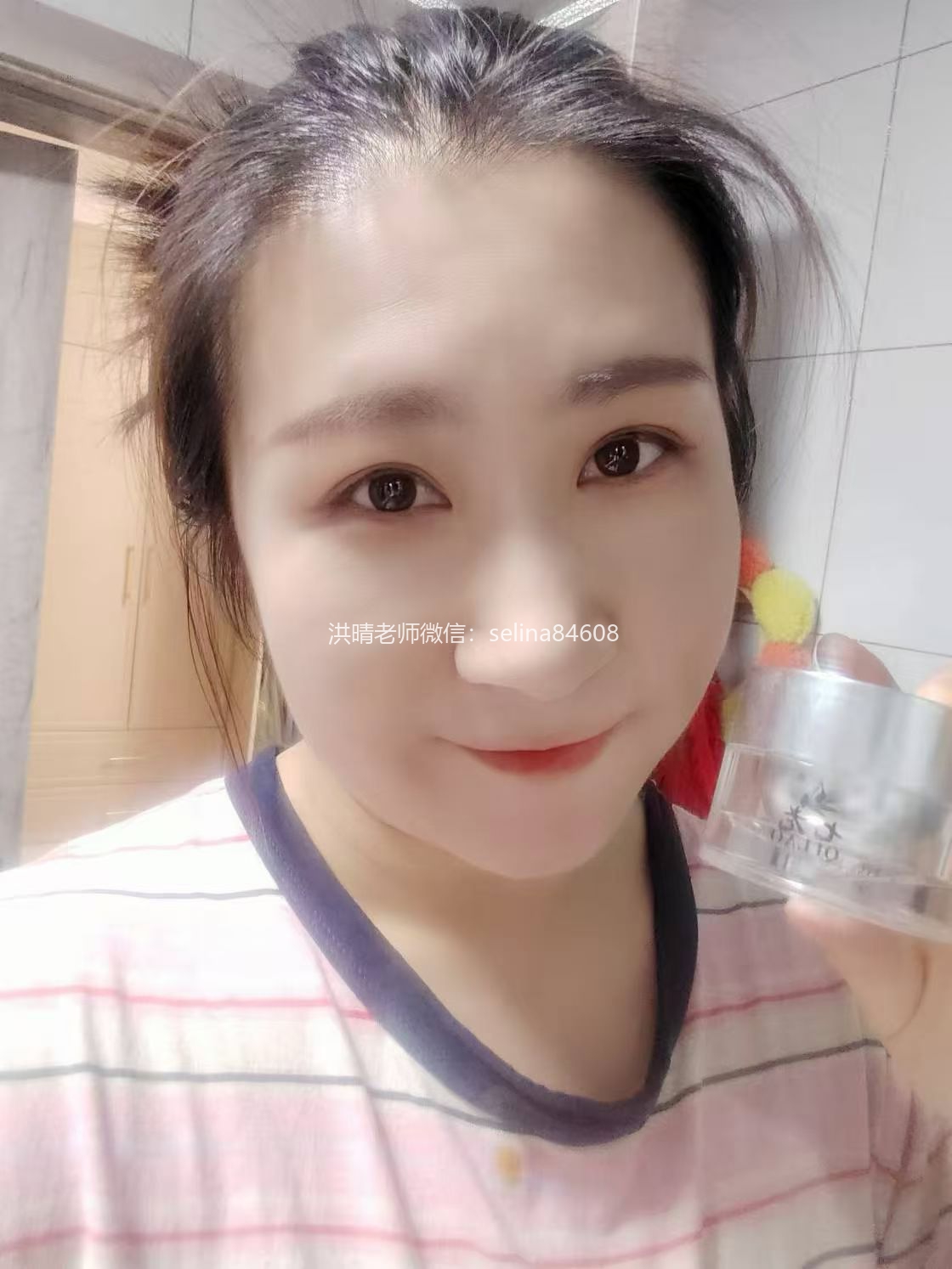 七老严重激素脸修复案例