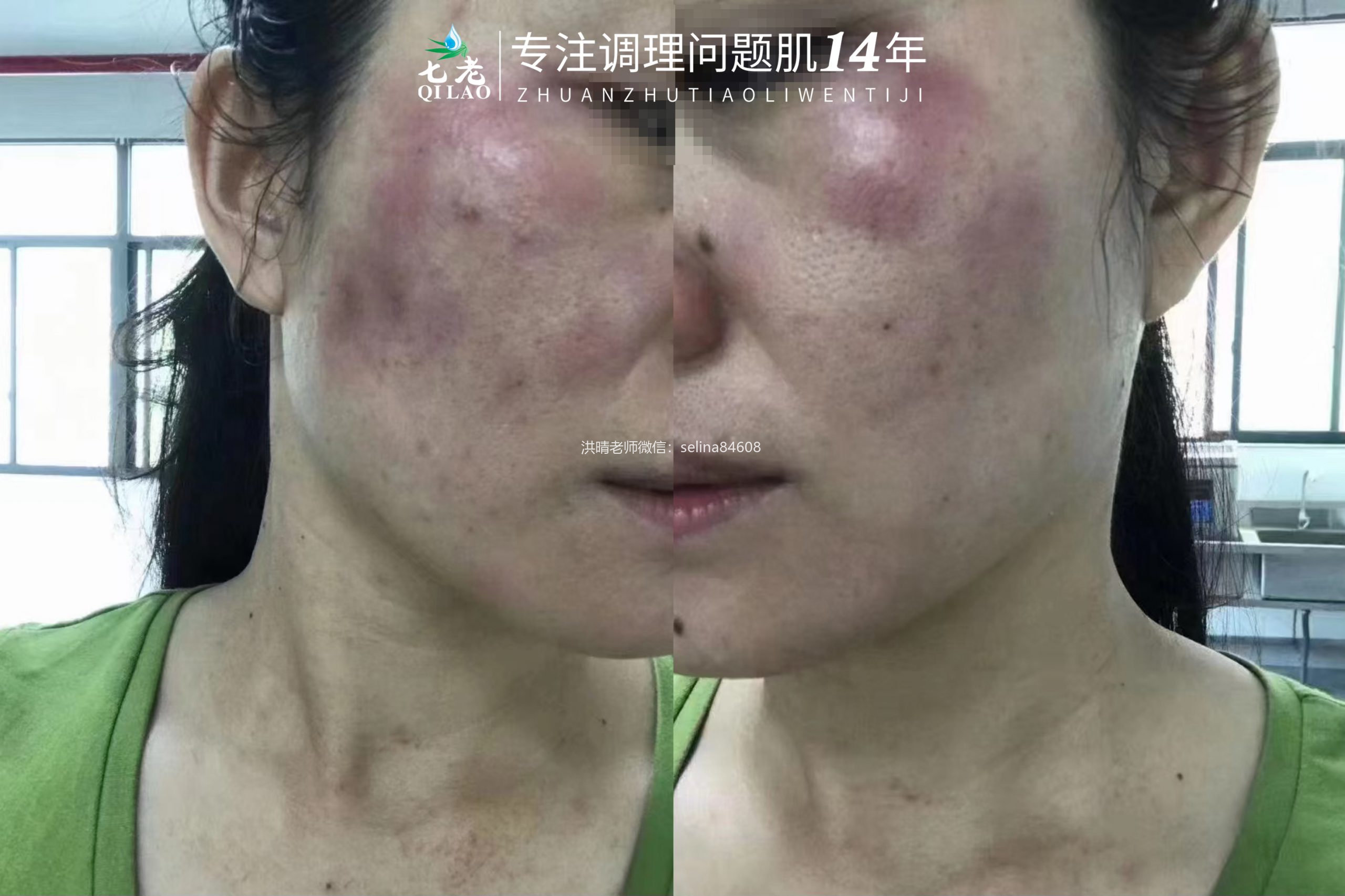 七老反复过敏修复案例