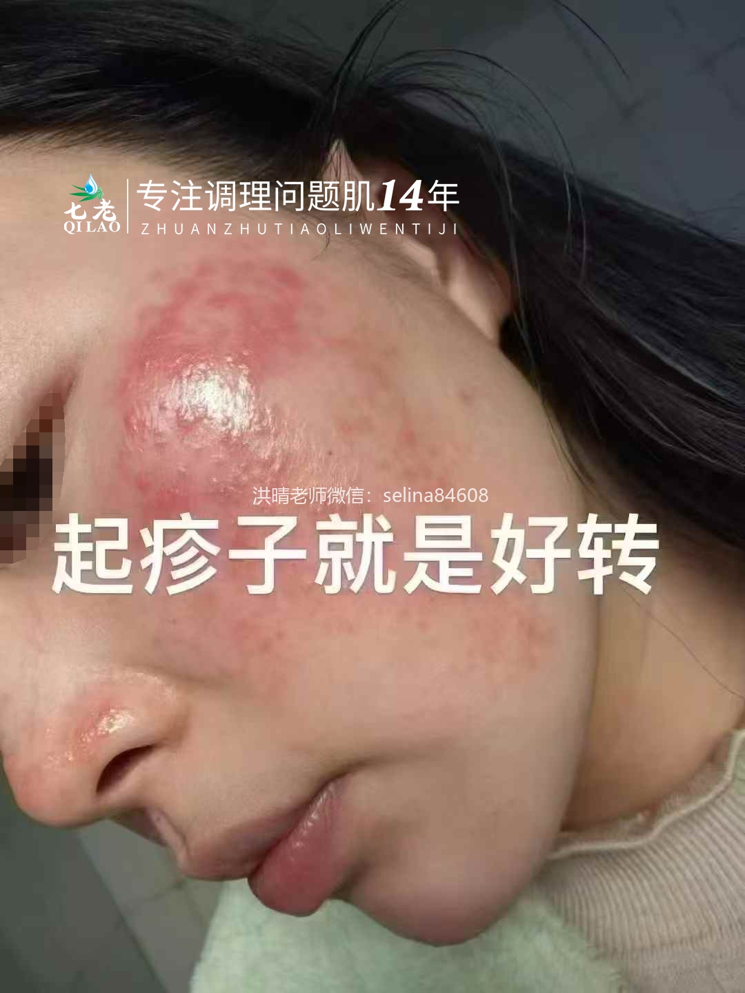 七老激素脸修护案例