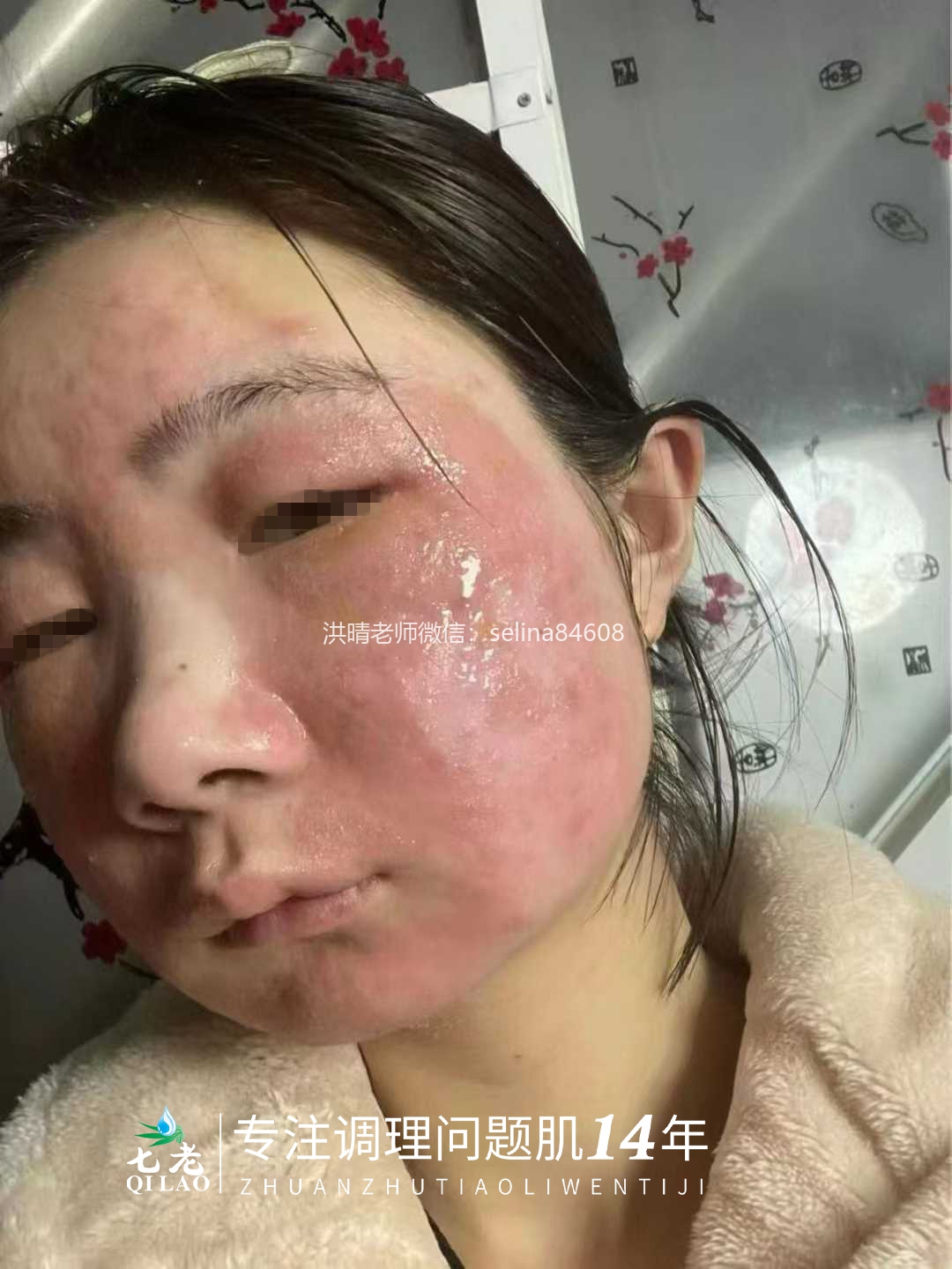 七老激素脸修复案例