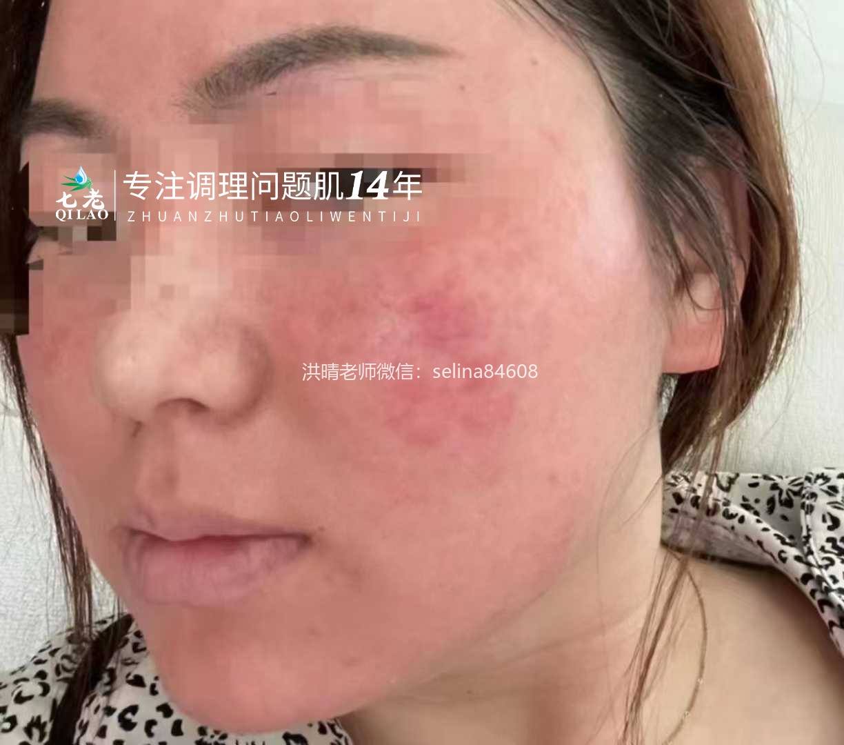 七老玫瑰脸修护案例