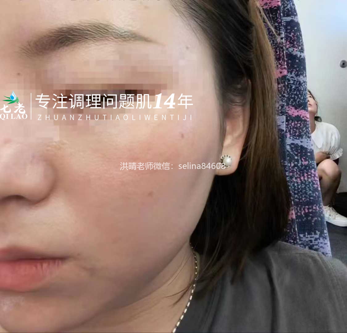 七老玫瑰脸修护案例