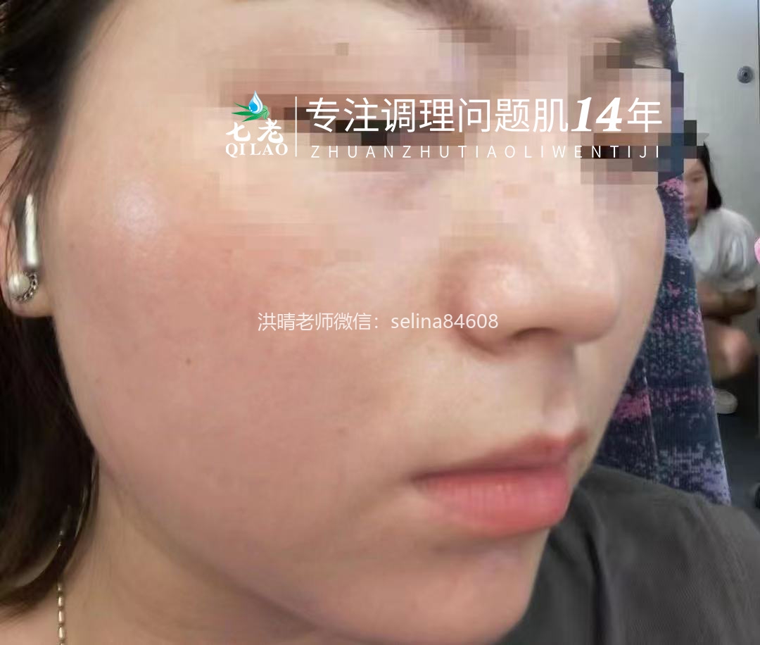 七老玫瑰脸修护案例