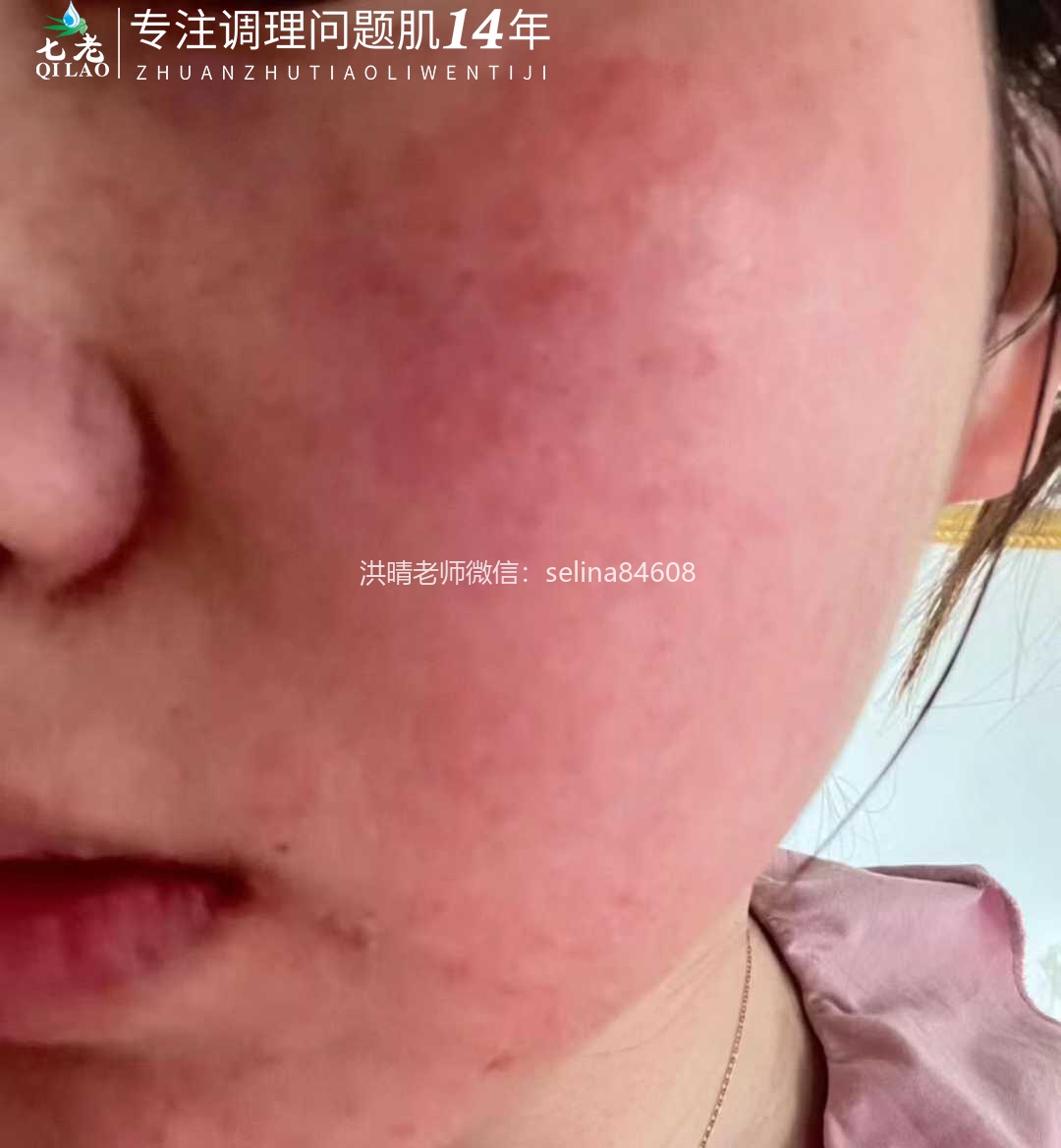 七老玫瑰脸修护案例