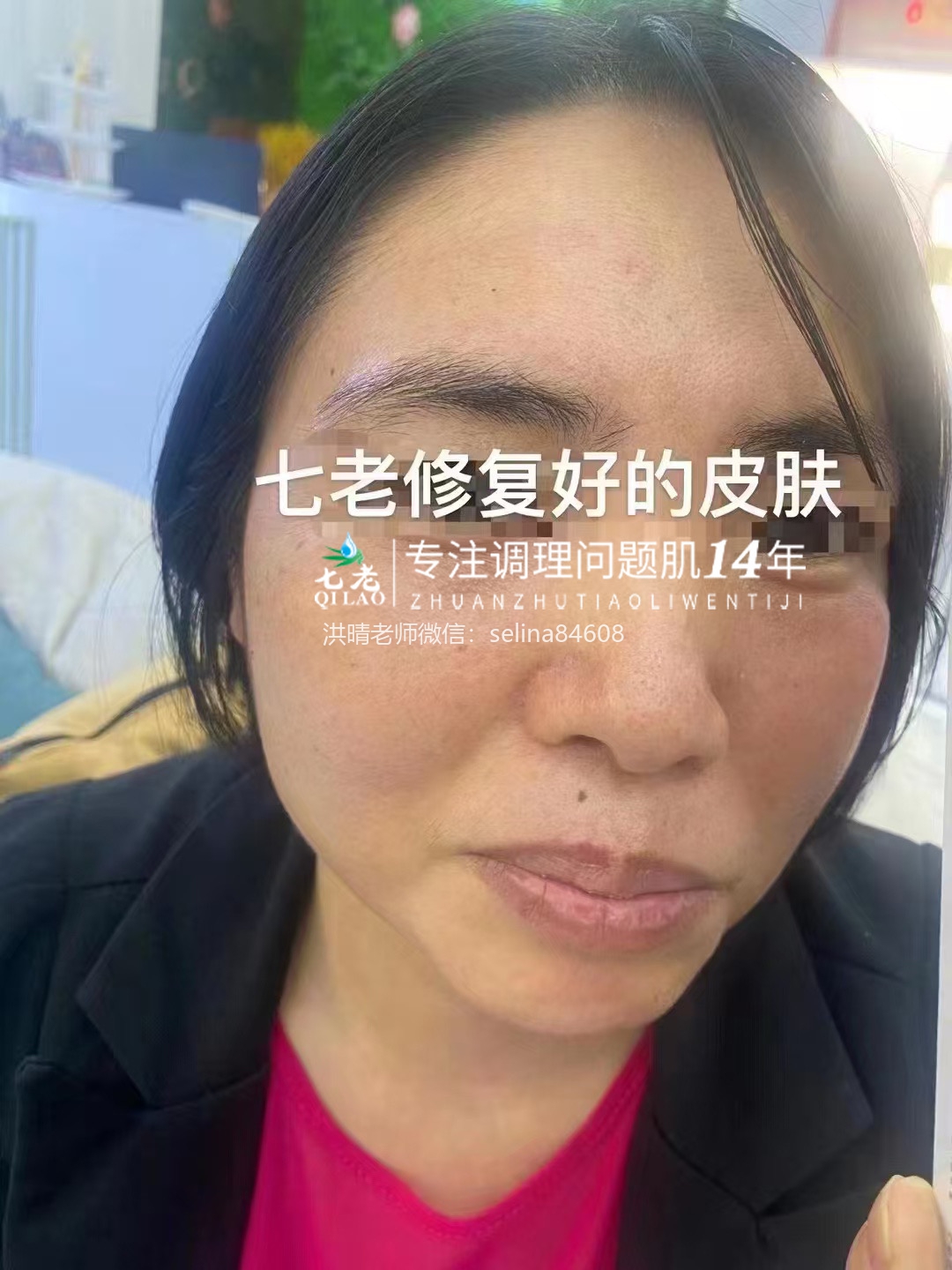 七老日光性皮炎修护案例