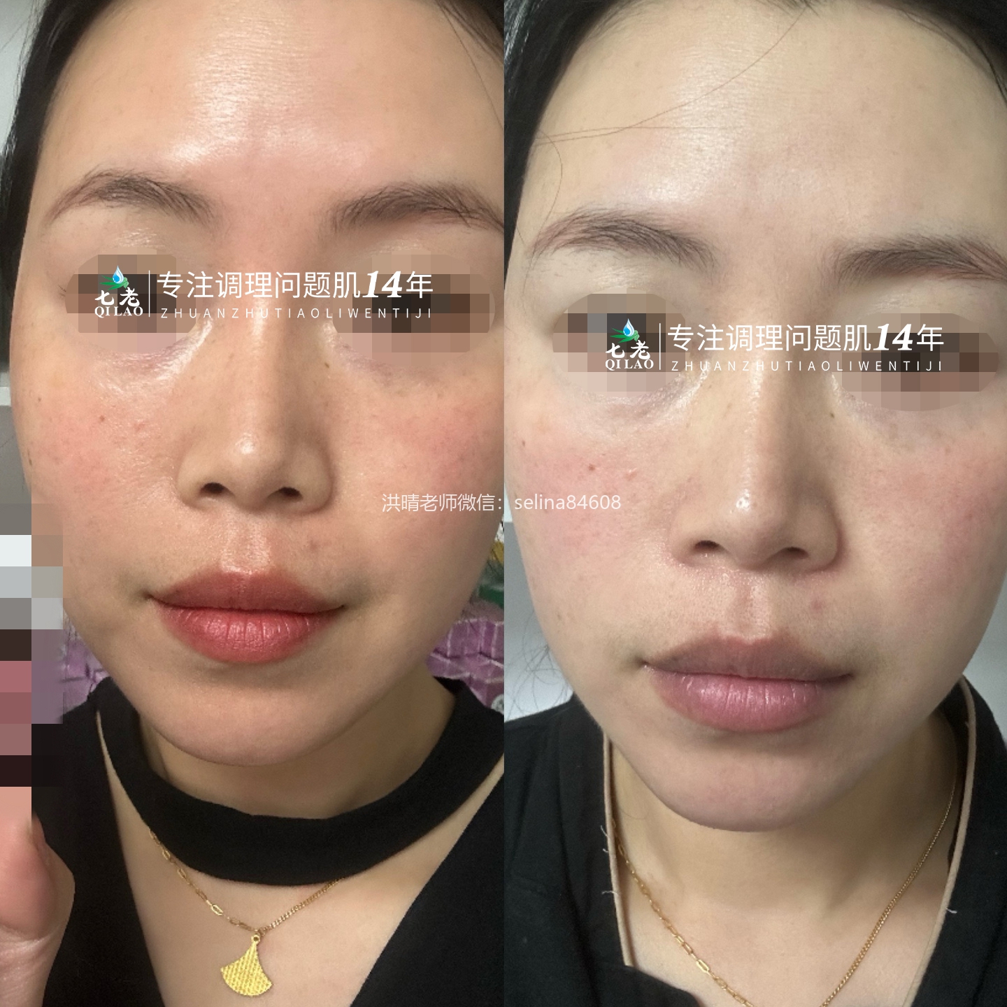 七老传明酸精华修护十天对比反馈