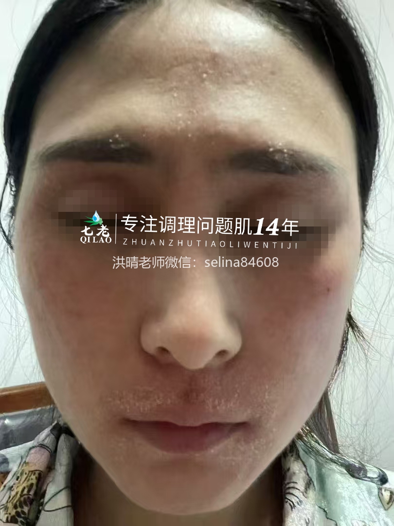 七老激素脸修护案例