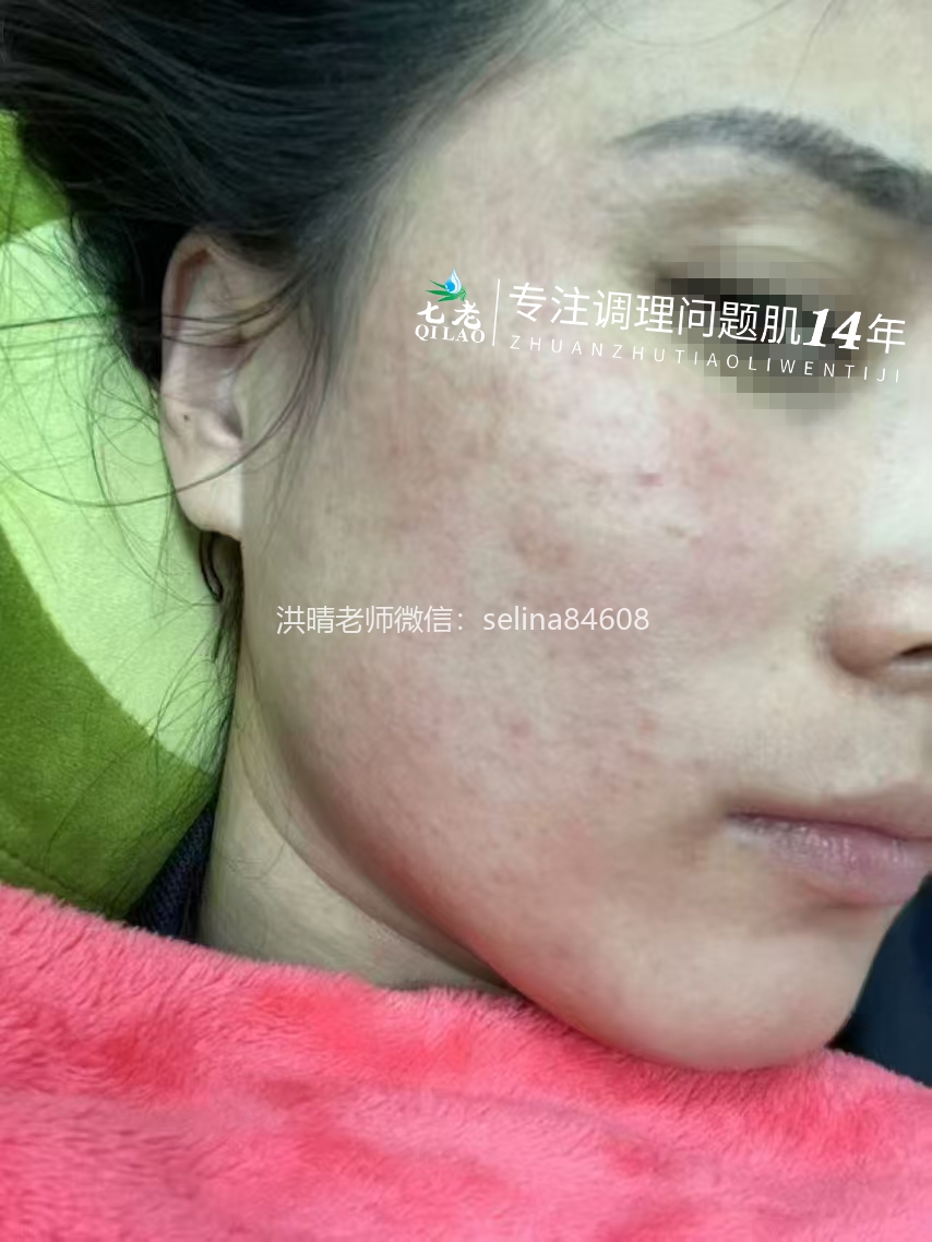 七老激素脸修护案例