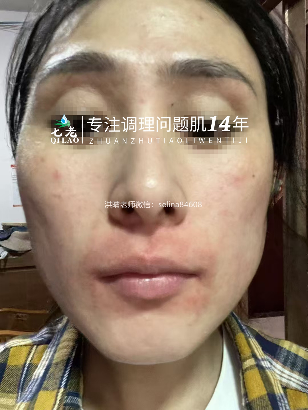 七老激素脸修护案例