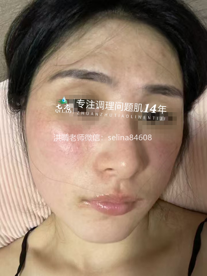 七老激素脸修护案例