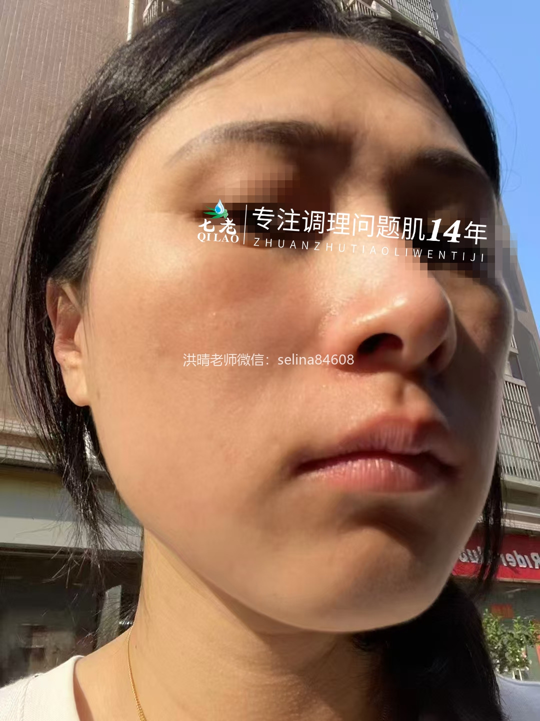 七老激素脸修护案例